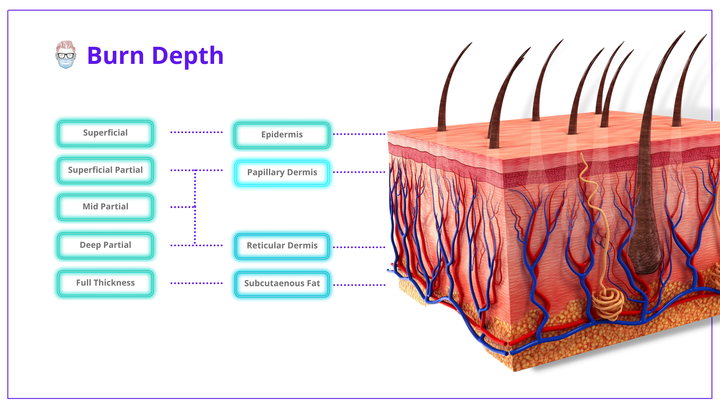 Burn Depth Classification Chart, Burn Classification, Depth, Burn, Chart, Superifical, 1st Degree, Superificial Partial, Mid Partial, Deep Partial, Full Thickness, 2nd Degree, 3rd Degree, Burn Depth