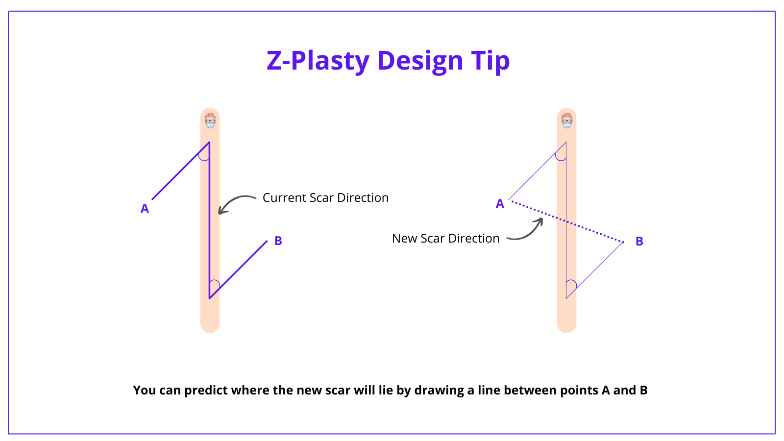Z-plasty, Z-plasty flap, z-plasty design, z-plasty technique, z-plasty complications