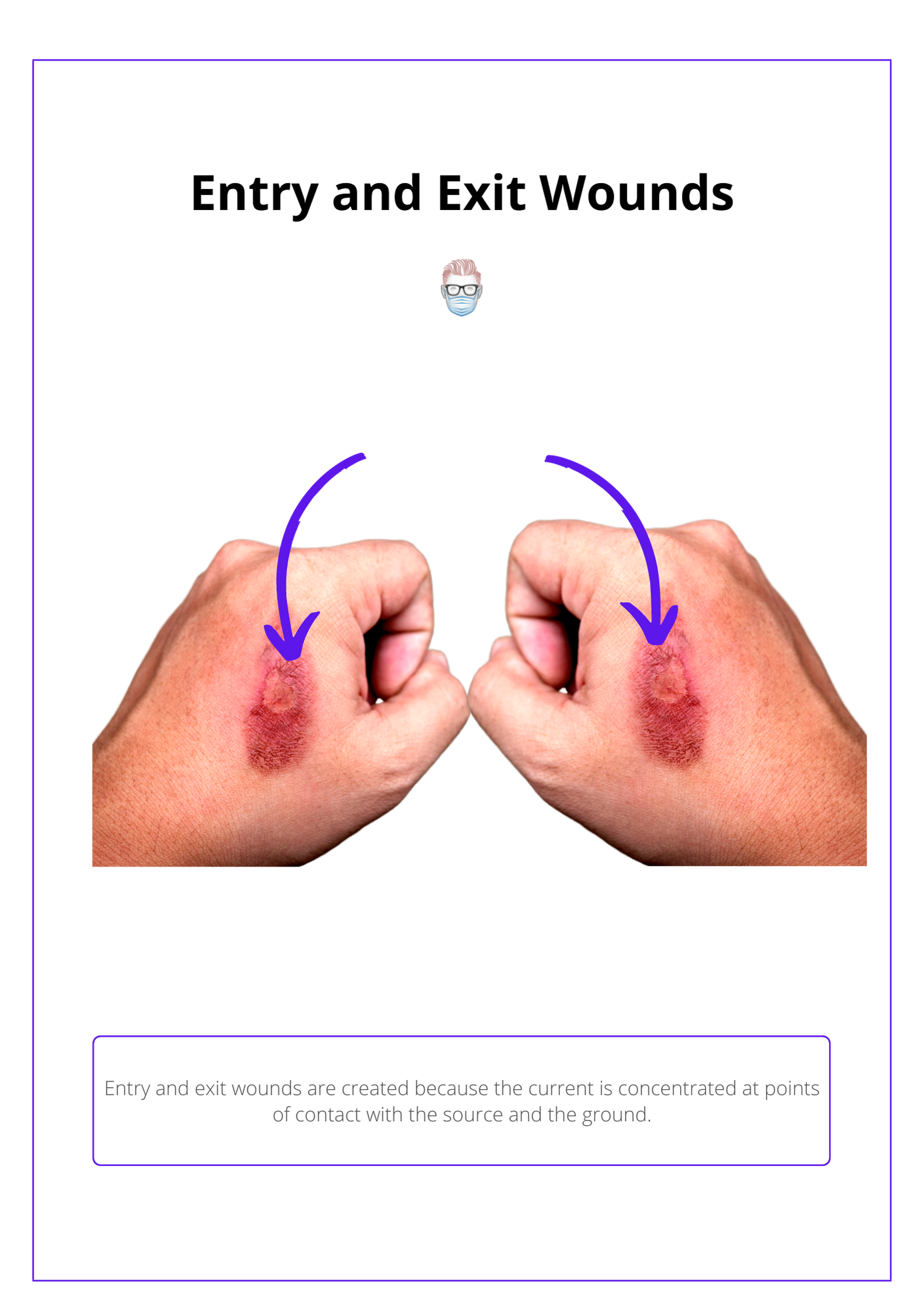Electrical Burns Causes Complications Management