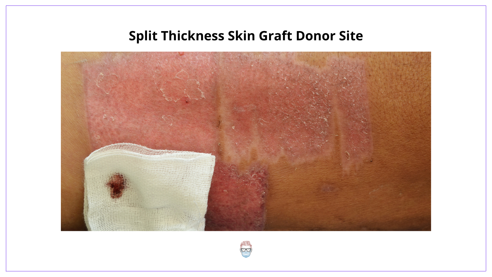 a split thickness skin graft donor site heals re-epithelialisation