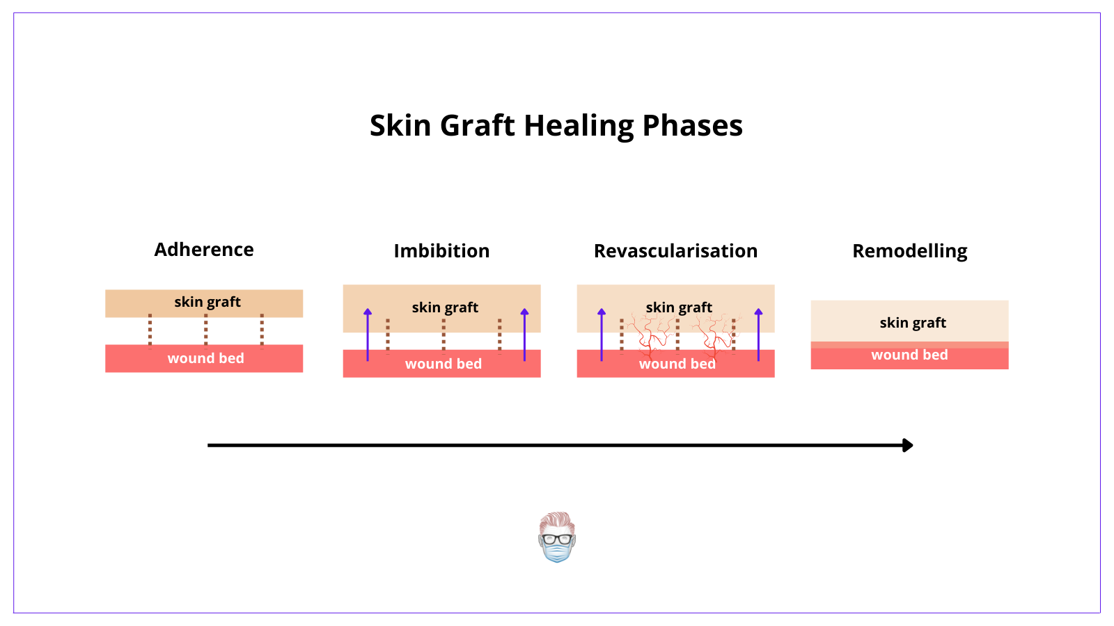 a skin graft heals by a process of adherence, imbibition, revascularisation and remodelling