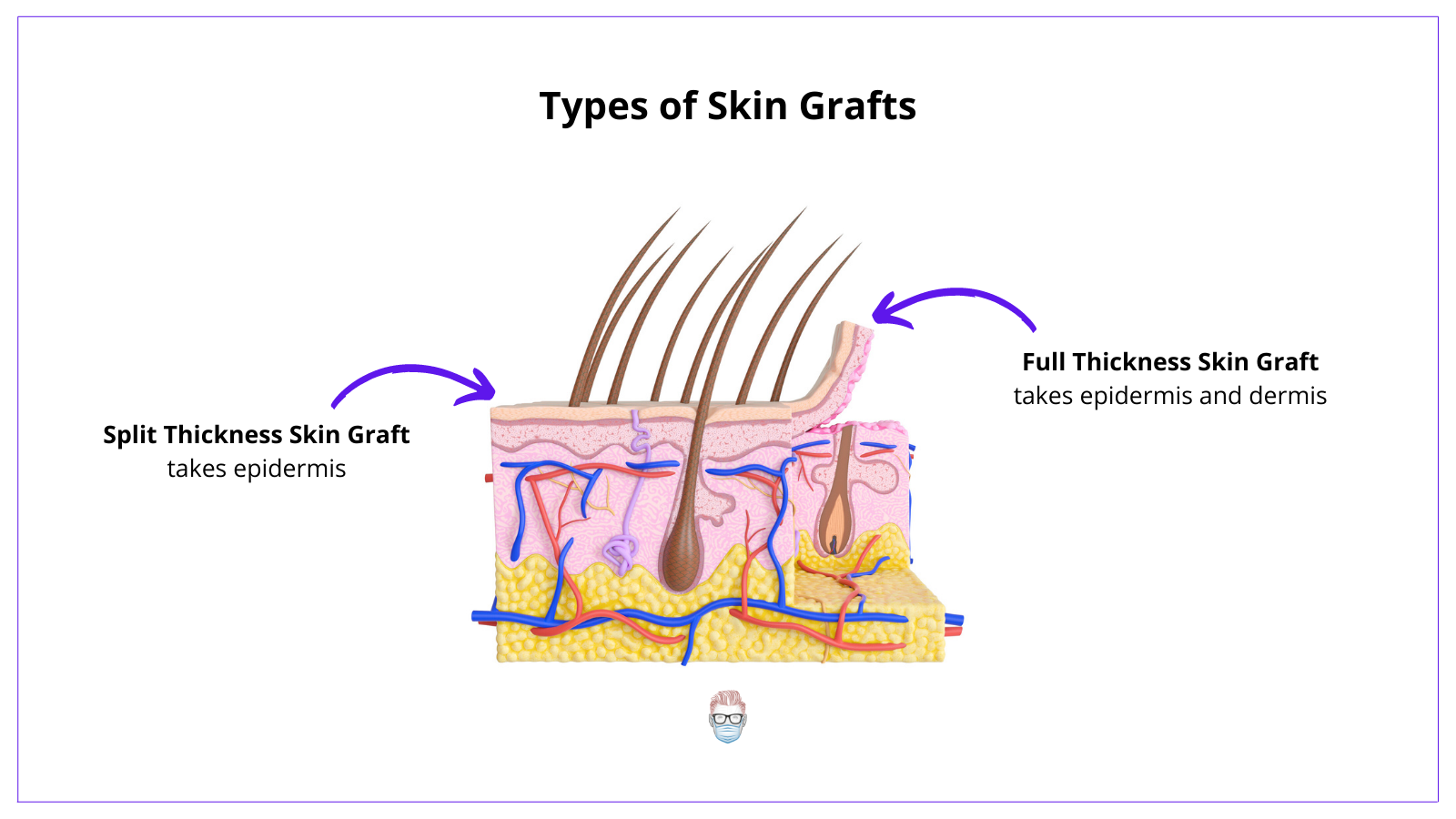 Full thickness skin grafts takes epidermis and variable amounts of dermis whilst split thicikness skin grafts takes epidermis only