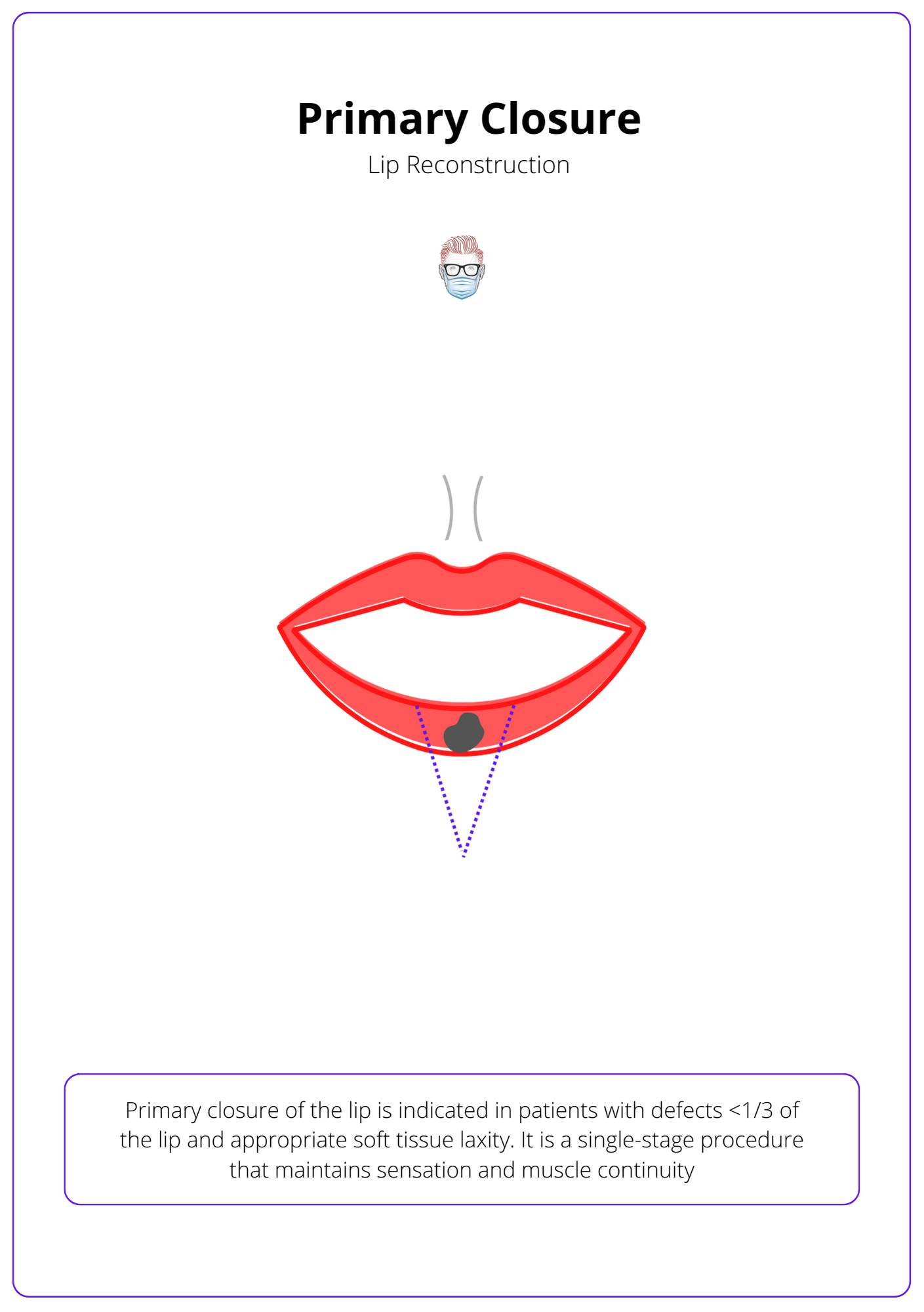 A labelled drawing of a red lip with a cancer. The lip is reconstruced with a blue dotted line to show a primary closure reconstruction