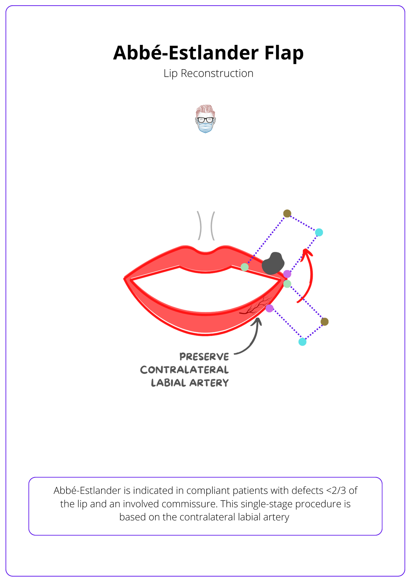 A labelled drawing of a red lip with a cancer. The lip is reconstruced with a blue dotted line to show a Abbe-Estlander flap. Arrows show the arteries and incisions