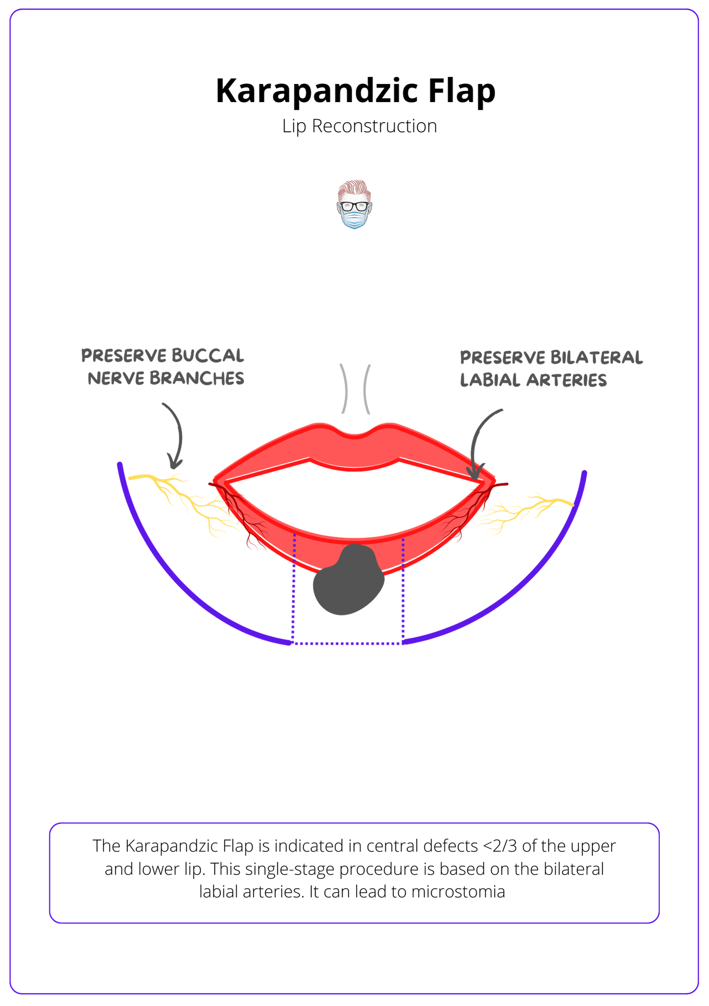 A labelled drawing of a red lip with a cancer. The lip is reconstruced with a blue dotted line to show a Karapandzic Flap. Arrows show the arteries and incisions