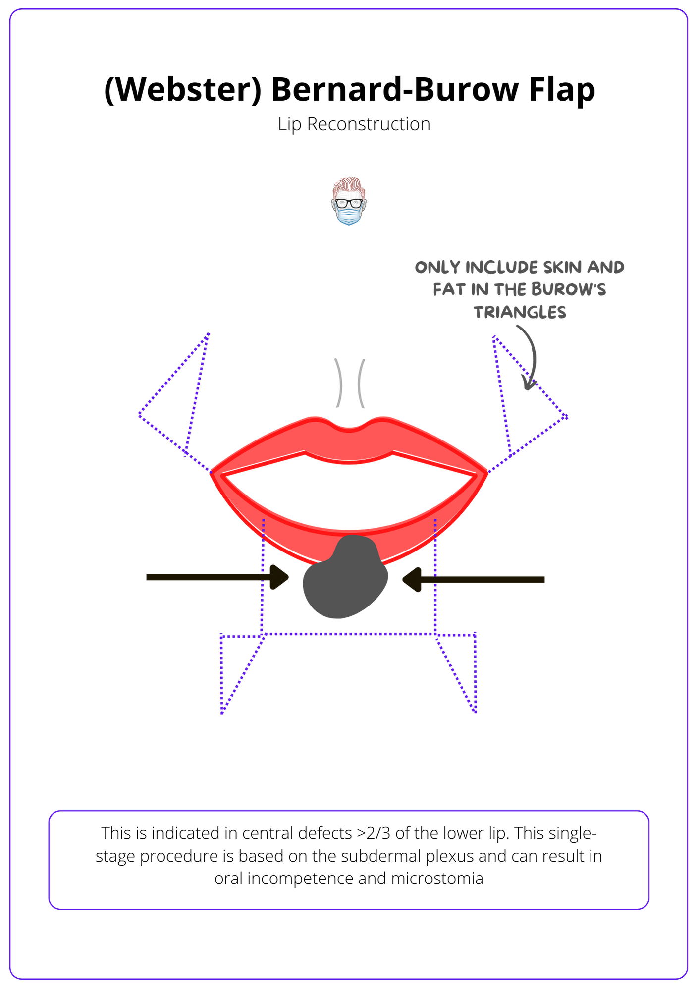 A labelled drawing of a red lip with a cancer. The lip is reconstruced with a blue dotted line to show a Bernard-Burow lip flap. Arrows show the arteries and incisions