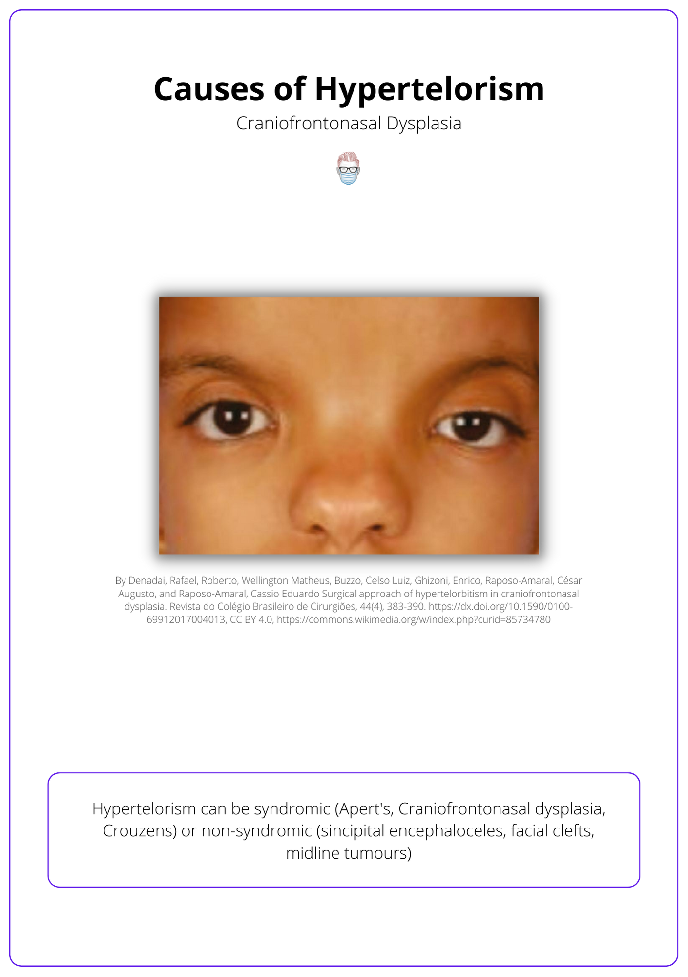 Causes of Hypertelorism, patient with craniofrontonasal dysplasia