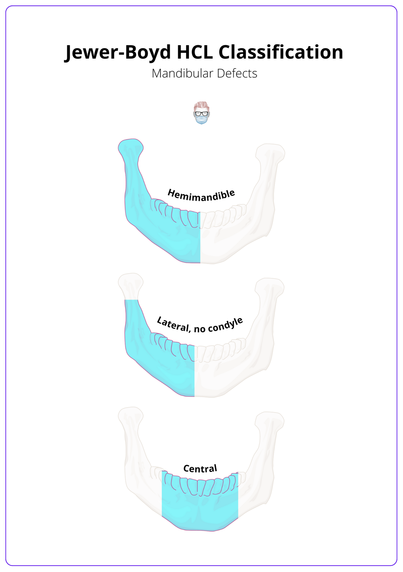 A labelled image showing the HCL classification for mandibular defects