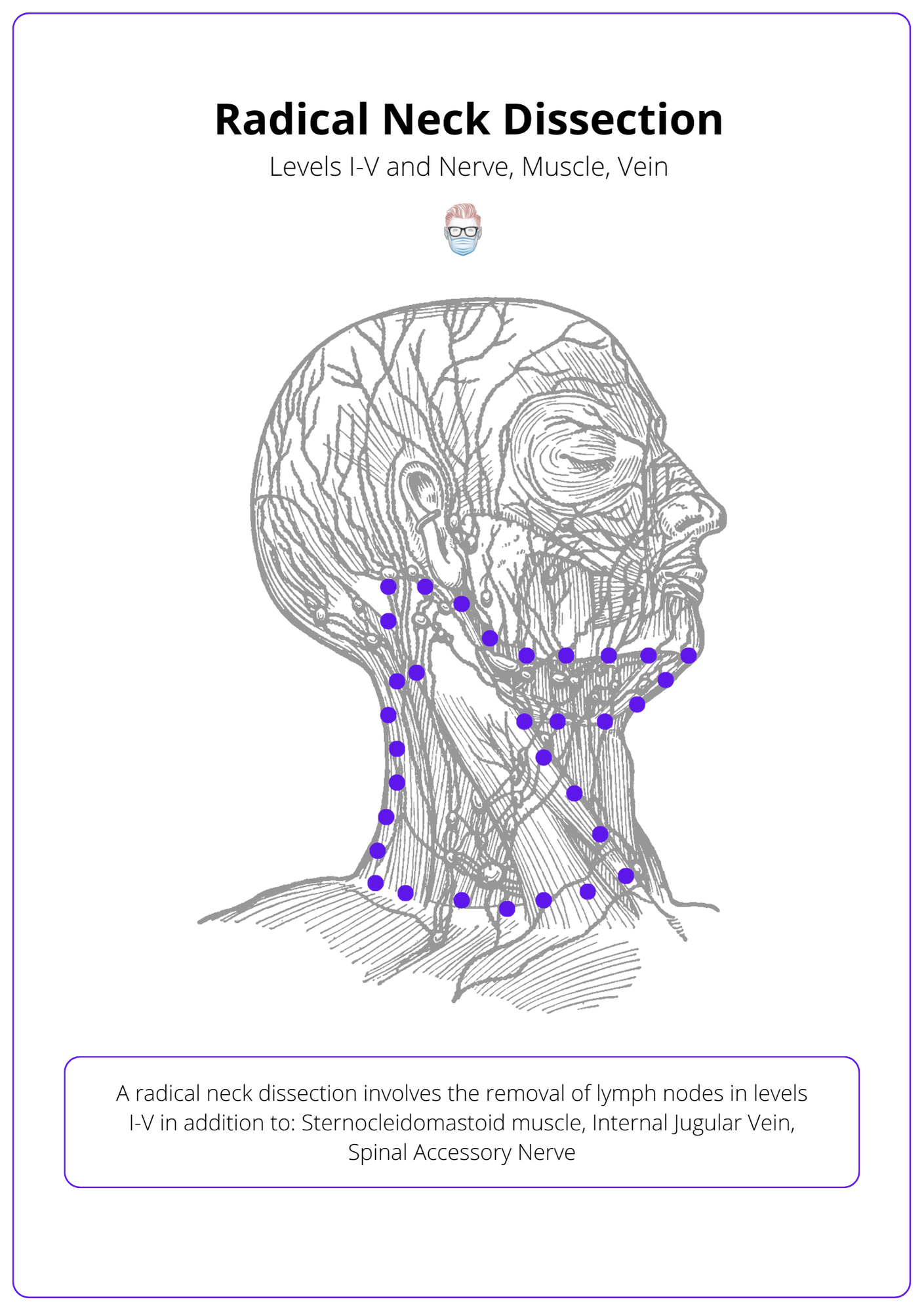 A diagram showing the anatomy of a radical neck dissection which involves removing levels 1-5 of the nodes, sternocleidomastoid muscle and spinal accessory nerve.