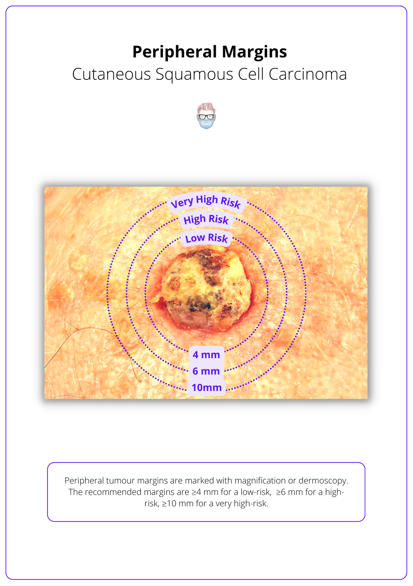 A labelled diagram showing the recommended peripheral margins for squamous cell carcinoma