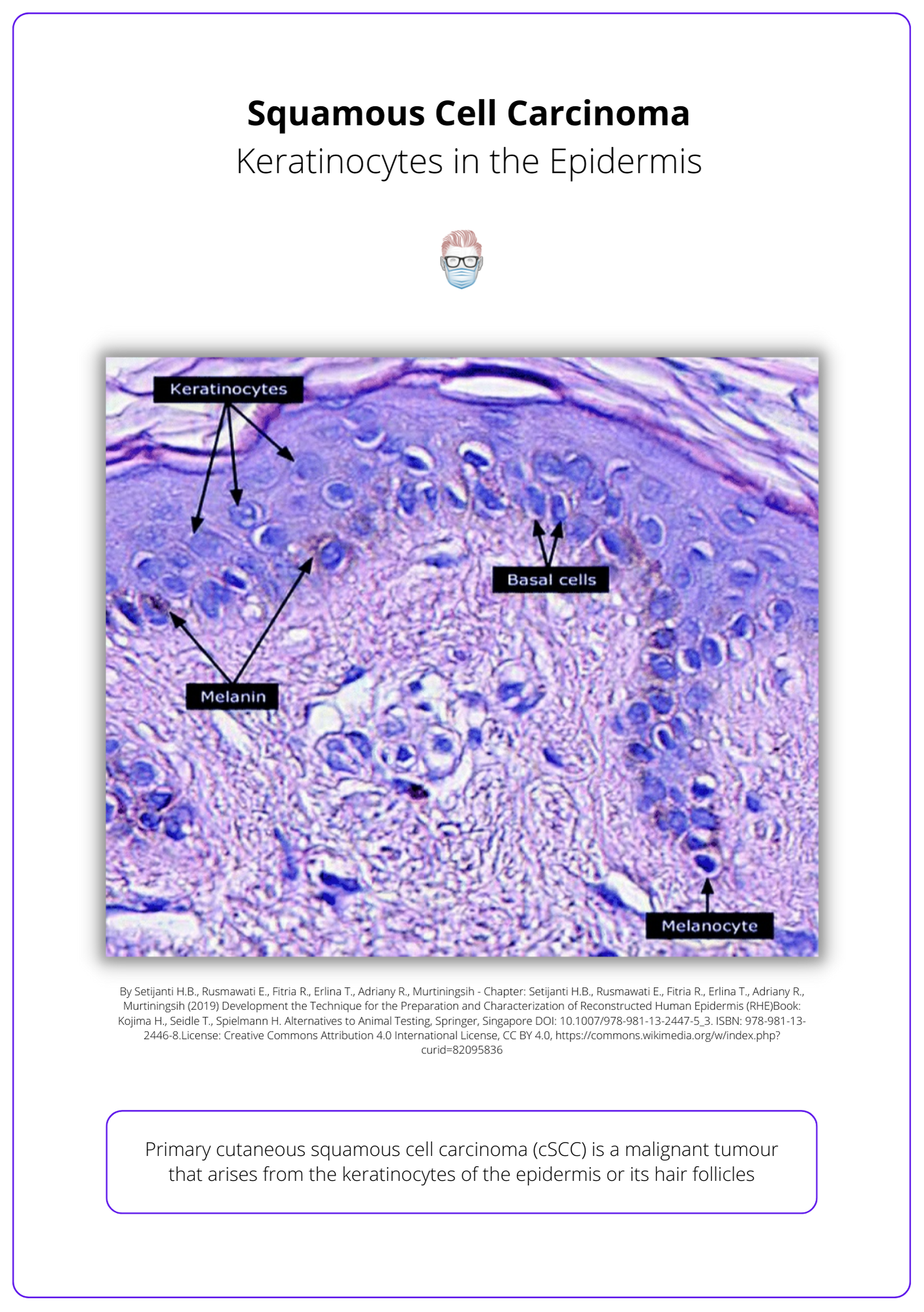 A micrograph showing cells of the epidermis that are important to skin or cutaneous squamous cell carcinoma (SCC(