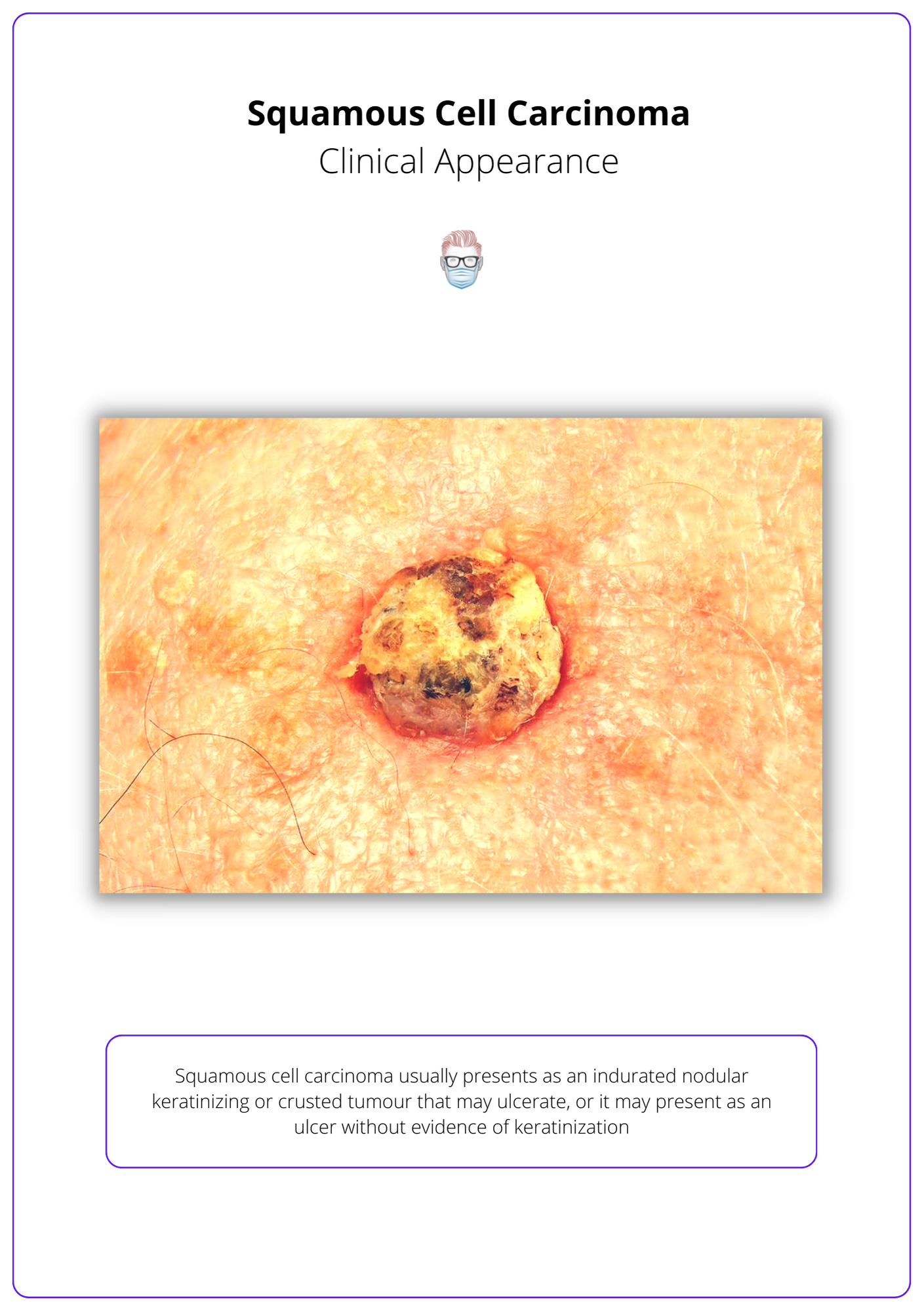 Squamous cell carcinoma usually presents as an indurated nodular keratinizing or crusted tumour that may ulcerate, or it may present as an ulcer without evidence of keratinization