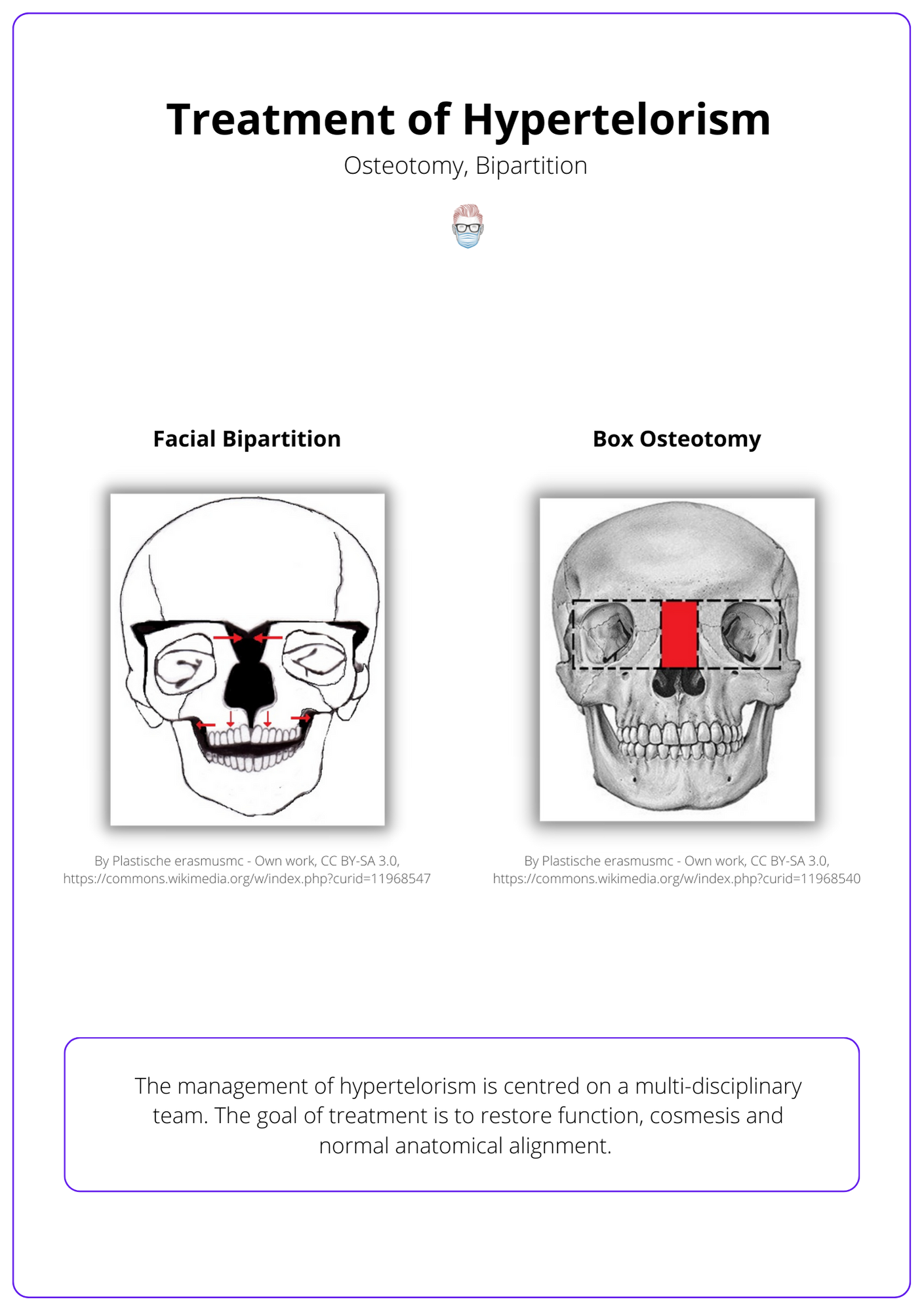 surgical treatments for hypertelorism