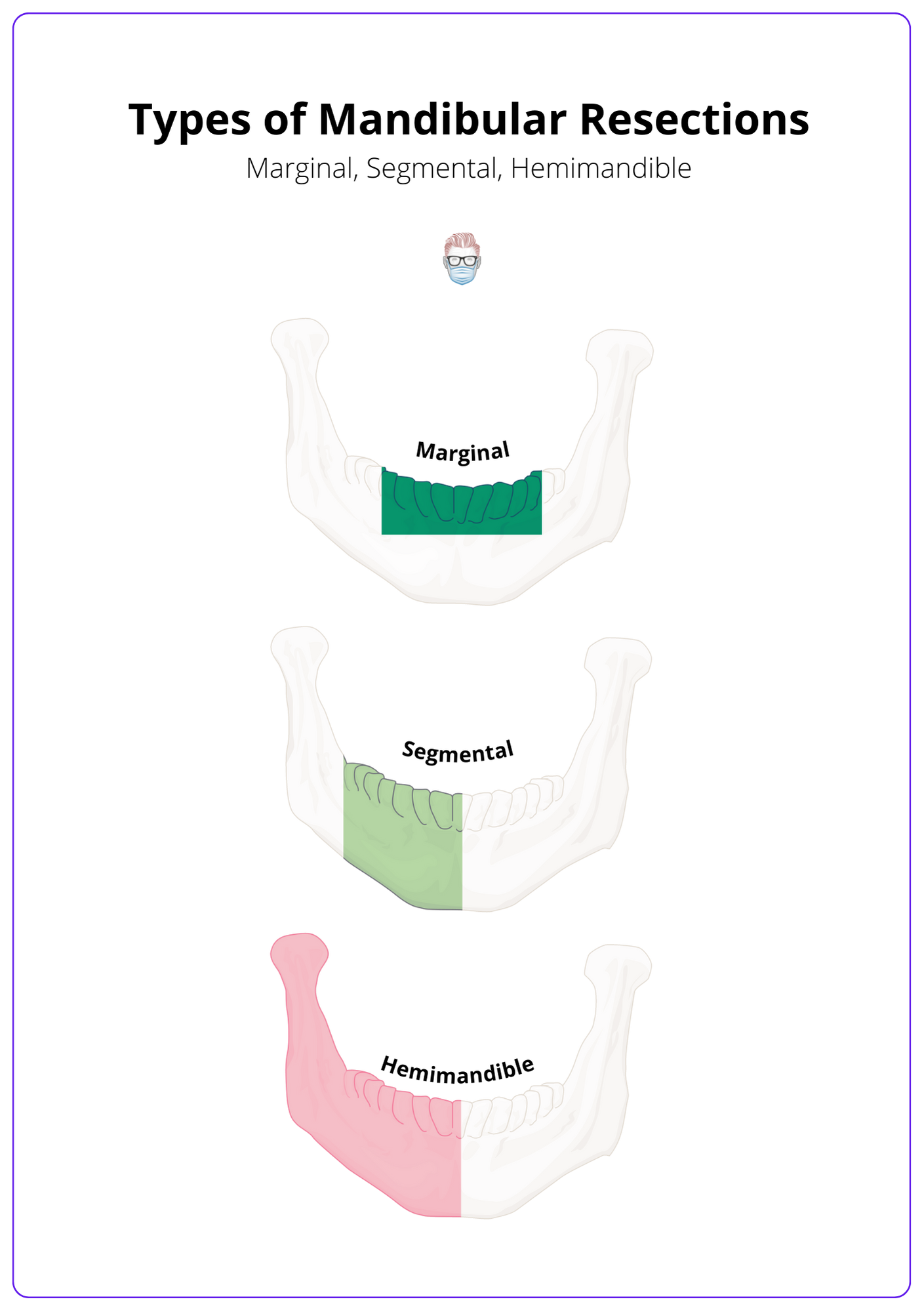Mandibular resections can be classified into 3 different types of mandibulectomies based on their width and length of resection: marginal (rim), segmental and hemimandile