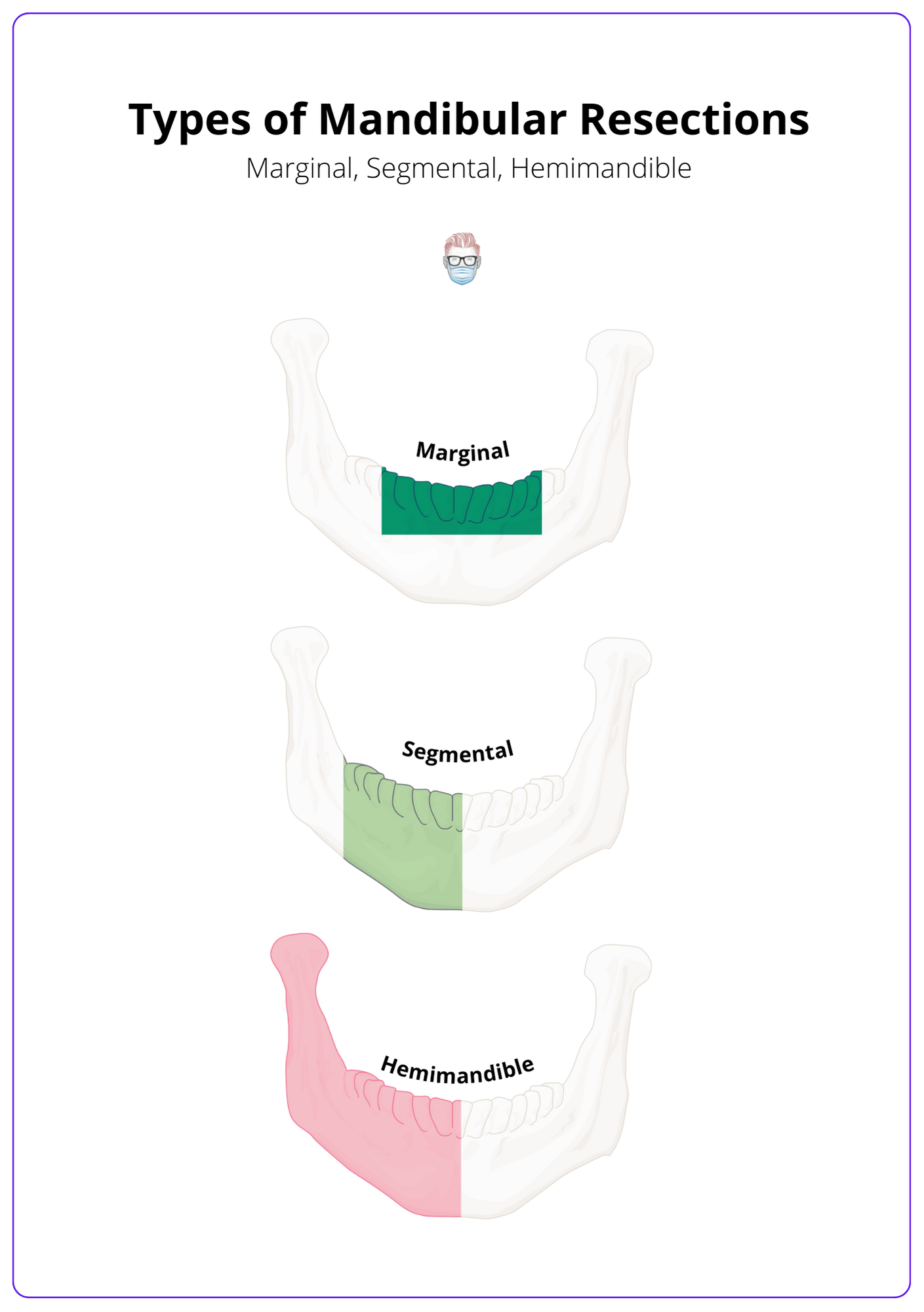 Hcl Classification For Mandibular Defects 11 H Hemima - vrogue.co