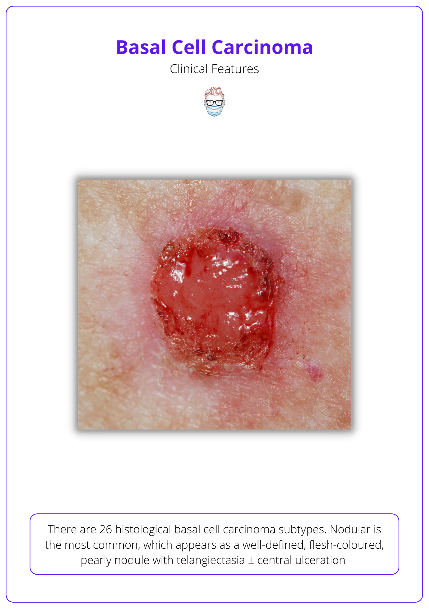 Basal Cell Carcinoma Bcc · Aetiology Diagnose Treat Follow Up