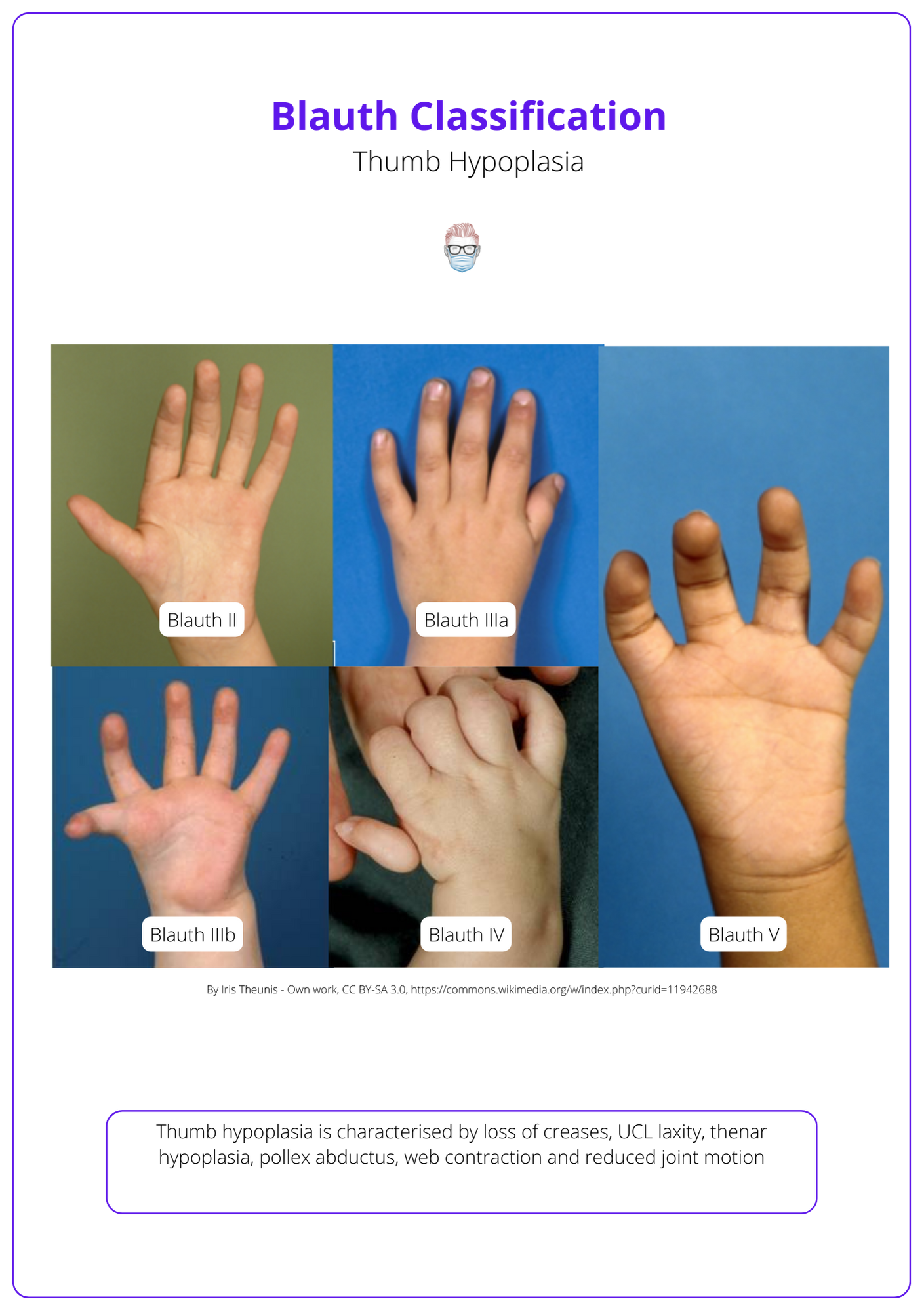 Blauth Classification of thumb hypoplasia