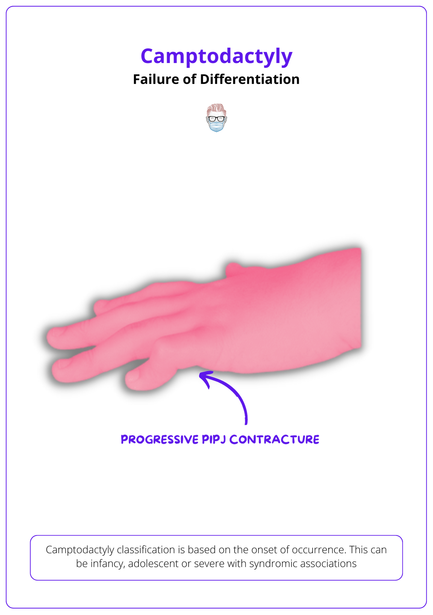 Camptodactyly classification, Failure of Differentiation in Camptodactyly