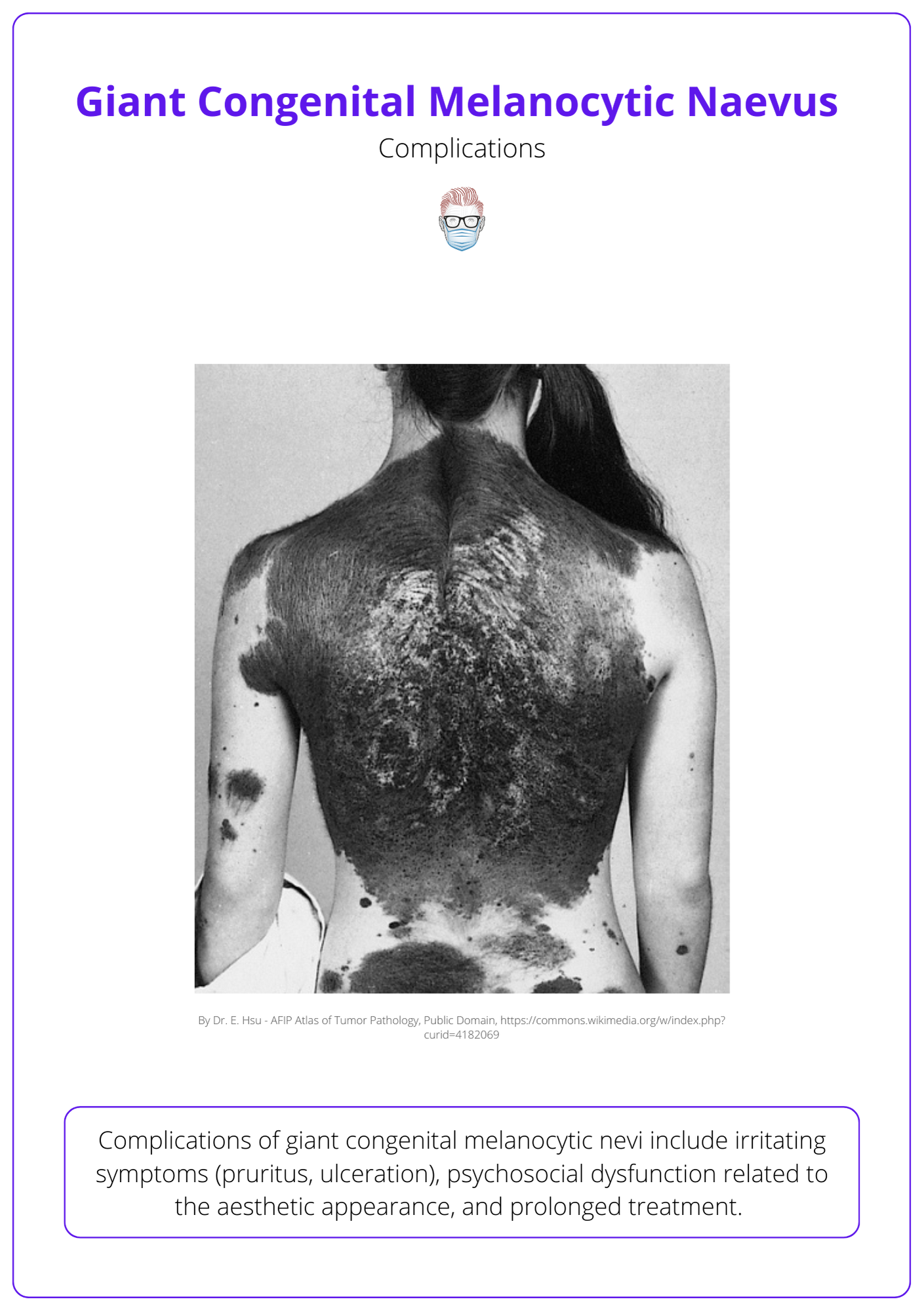 This illustrates the complications of giant congenital melanocytic naevus.
