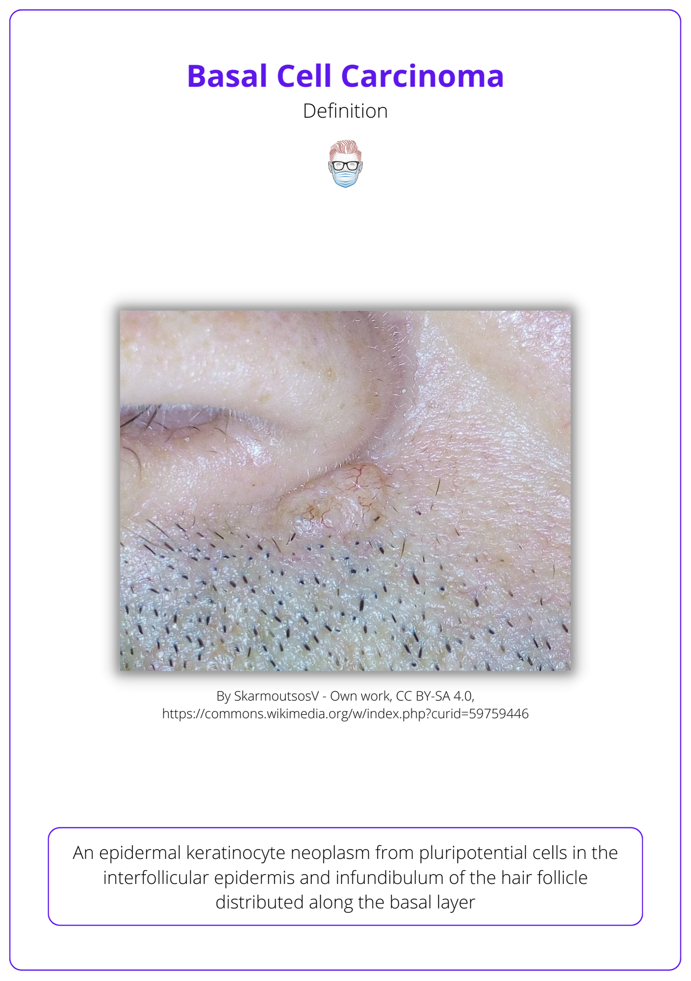 Basal Cell Carcinoma Bcc · Aetiology Diagnose Treat Follow Up