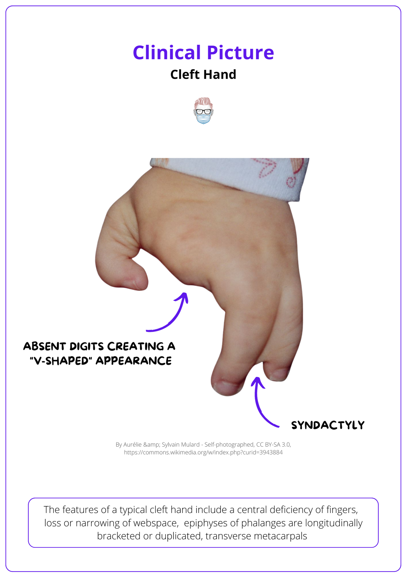 Hands of subjects with the 1q deletion. Small hands with distinctive