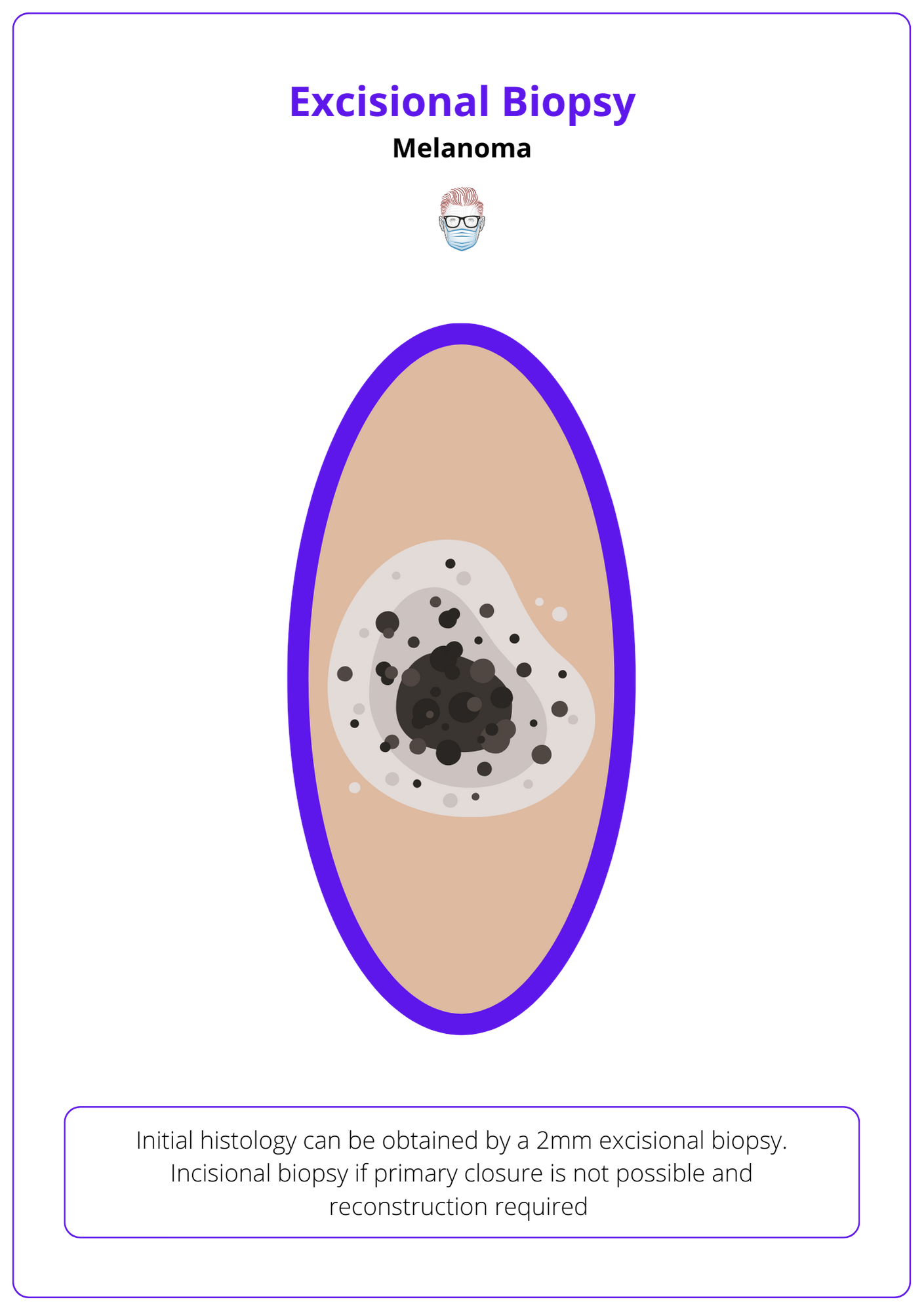 2mm Excisional Biopsy of a Melanoma, Diagnosis of Melanoma