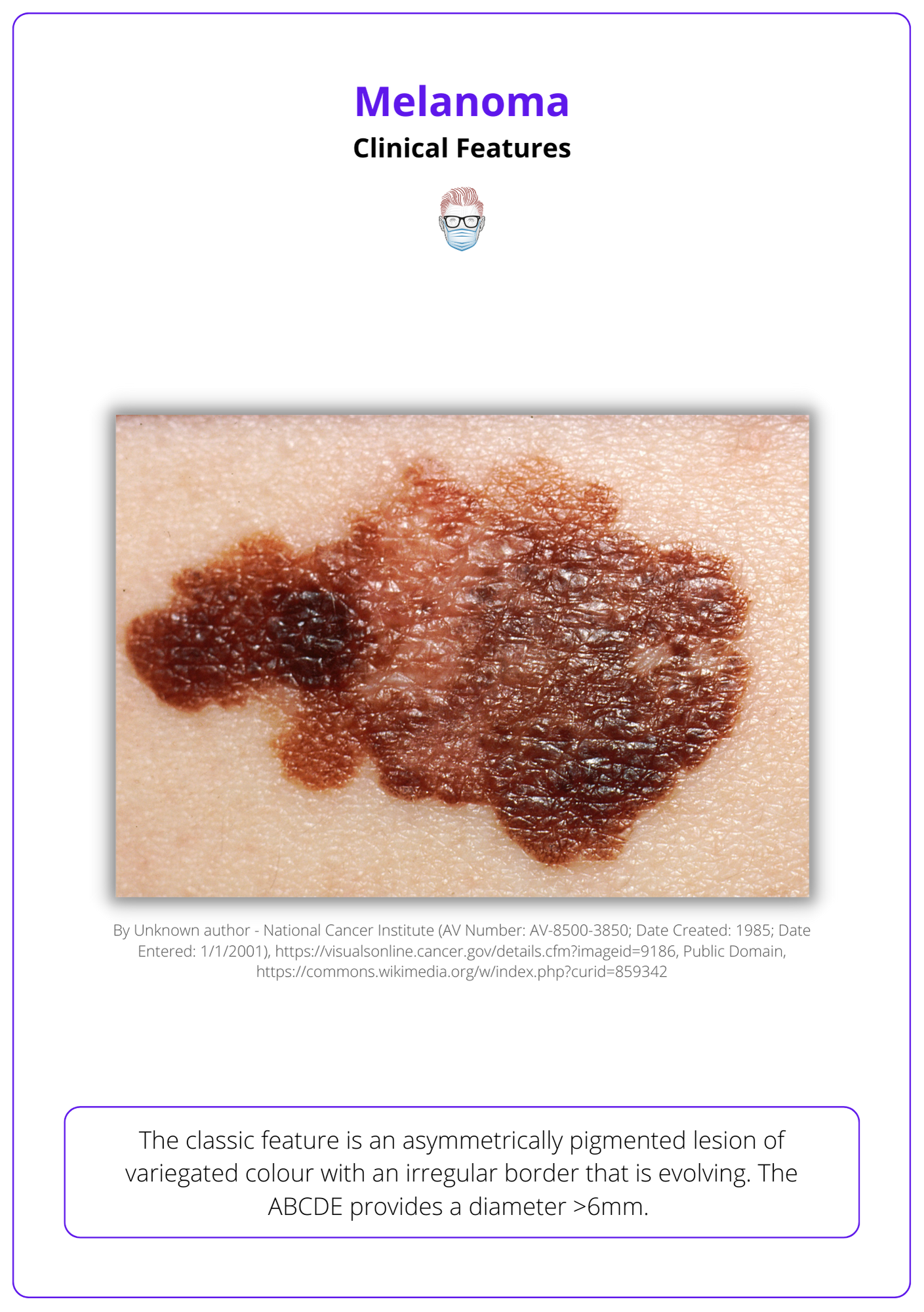This image shows Clinical Features of Melanoma.