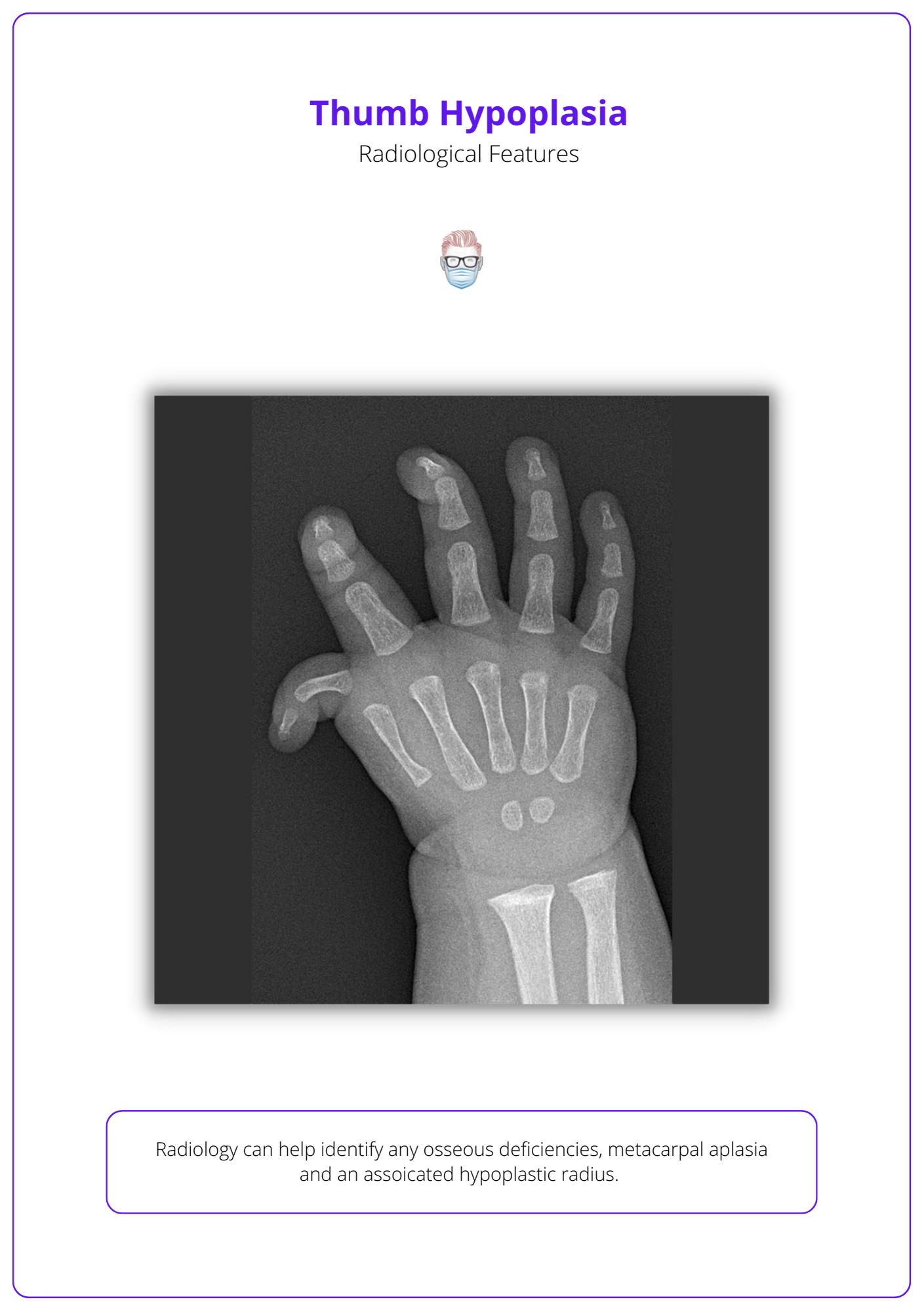 Radiological Features of Thumb Hypoplasia, Diagnosing Thumb Hypoplasia