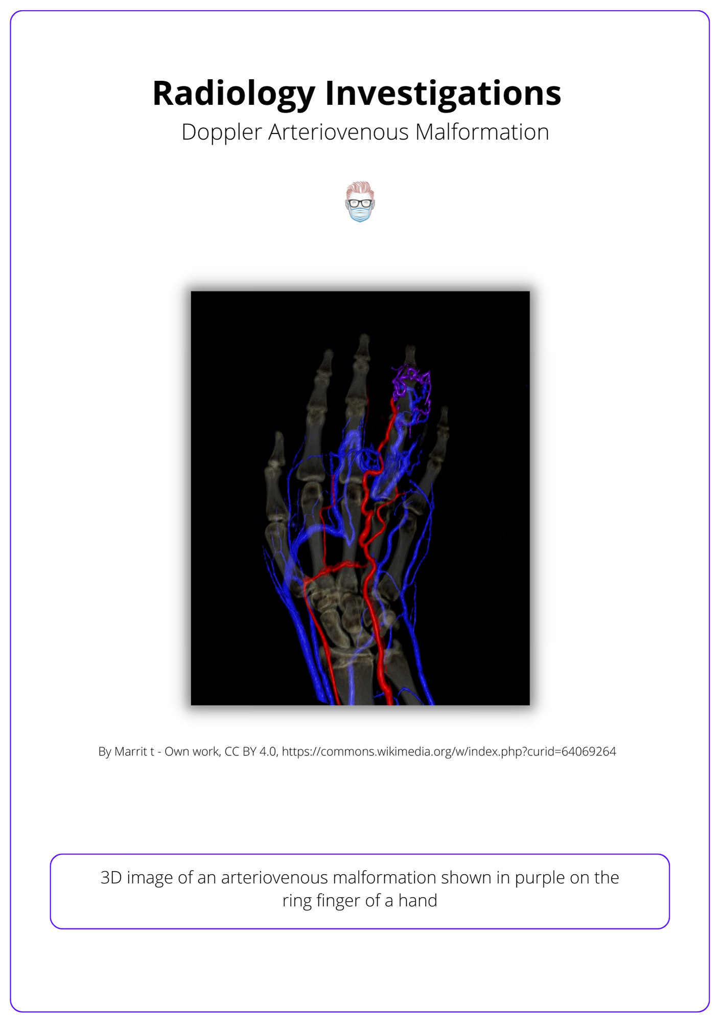 Doppler of Vascular Anomaly