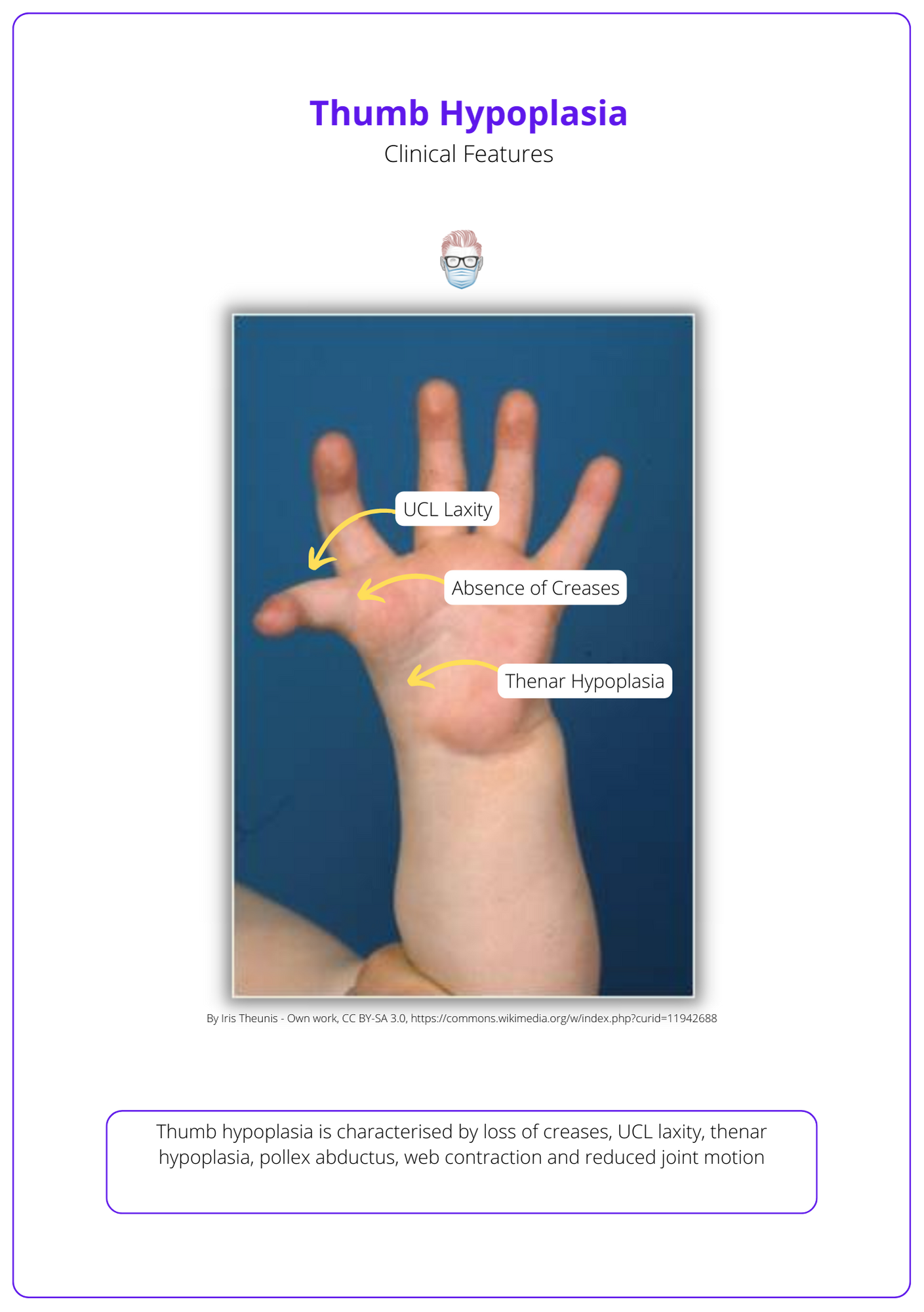 Clinical Features of Thumb Hypoplasia, Thumb Hypoplasia signs