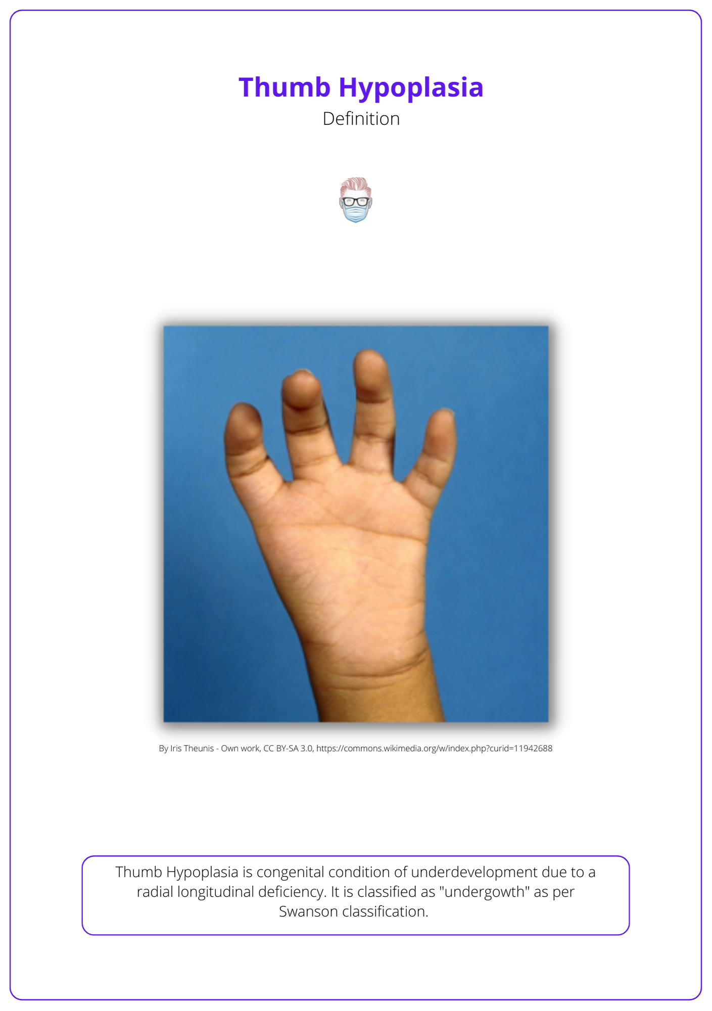 Definition of Thumb Hypoplasia