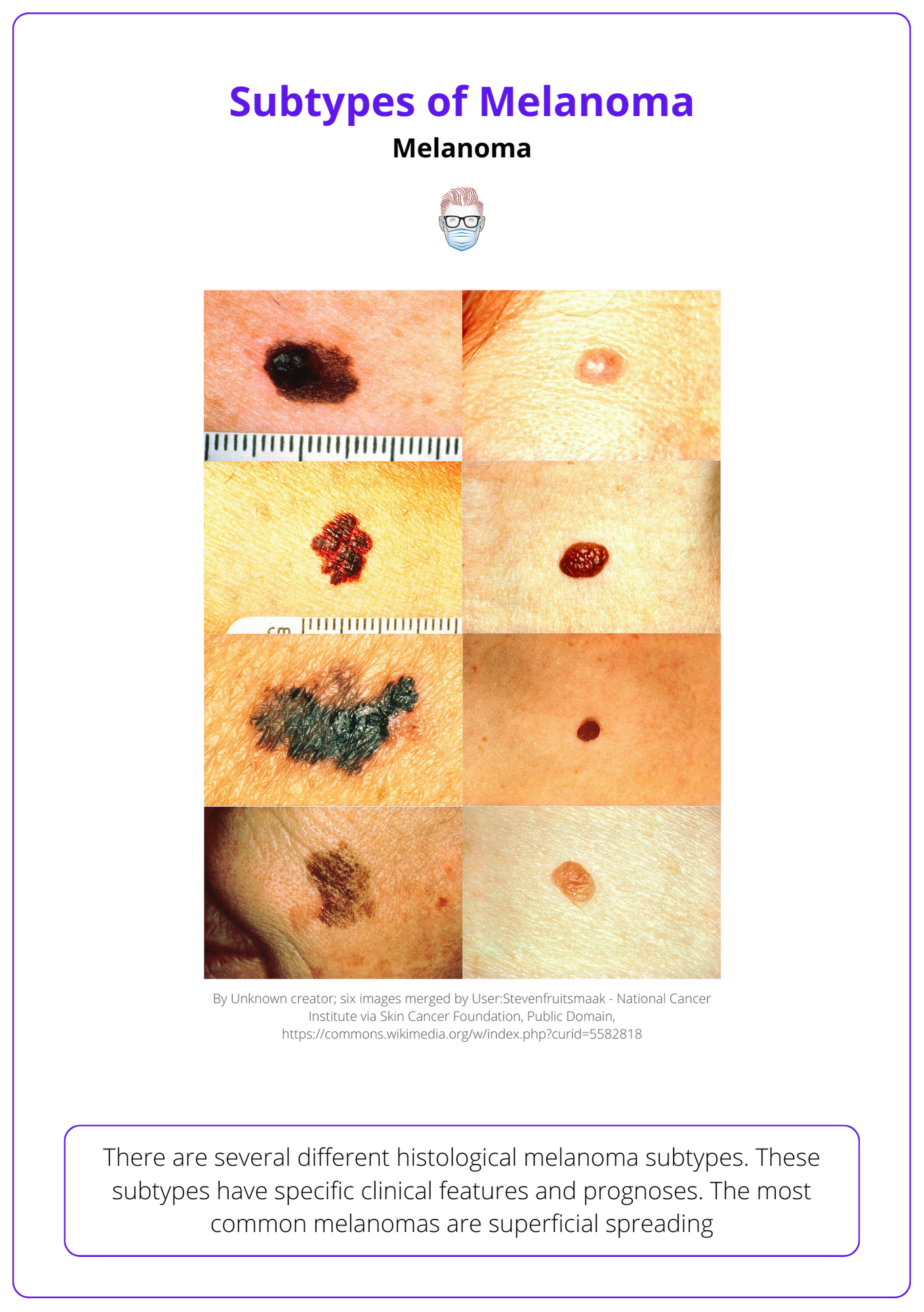 Melanoma types classification