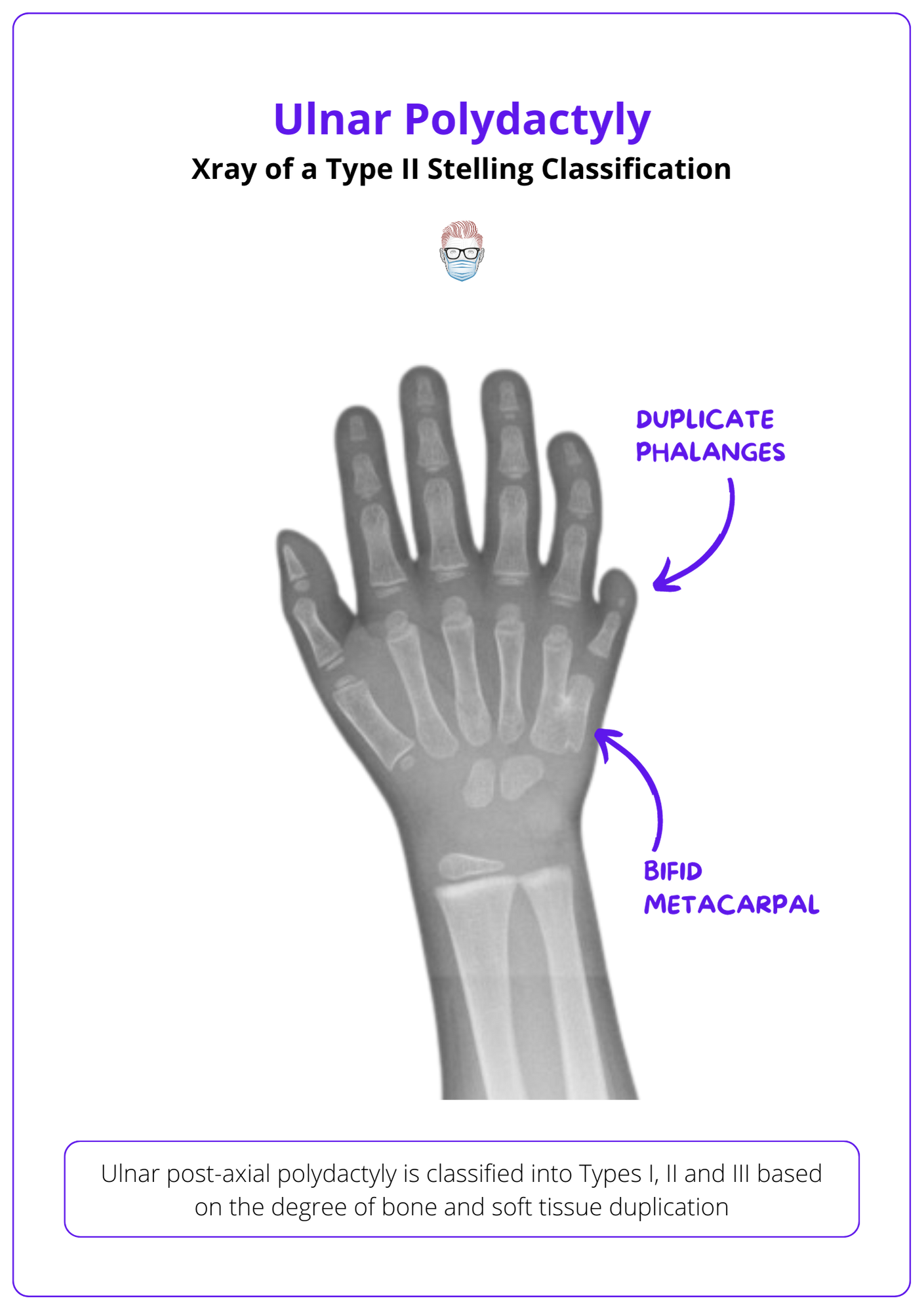 X-ray representation of type II Stelling Classification.