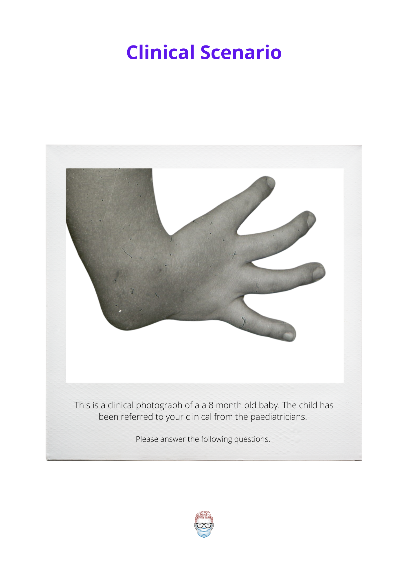 Ulnar Longitudinal Deficiency (Ulnar Club Hand)