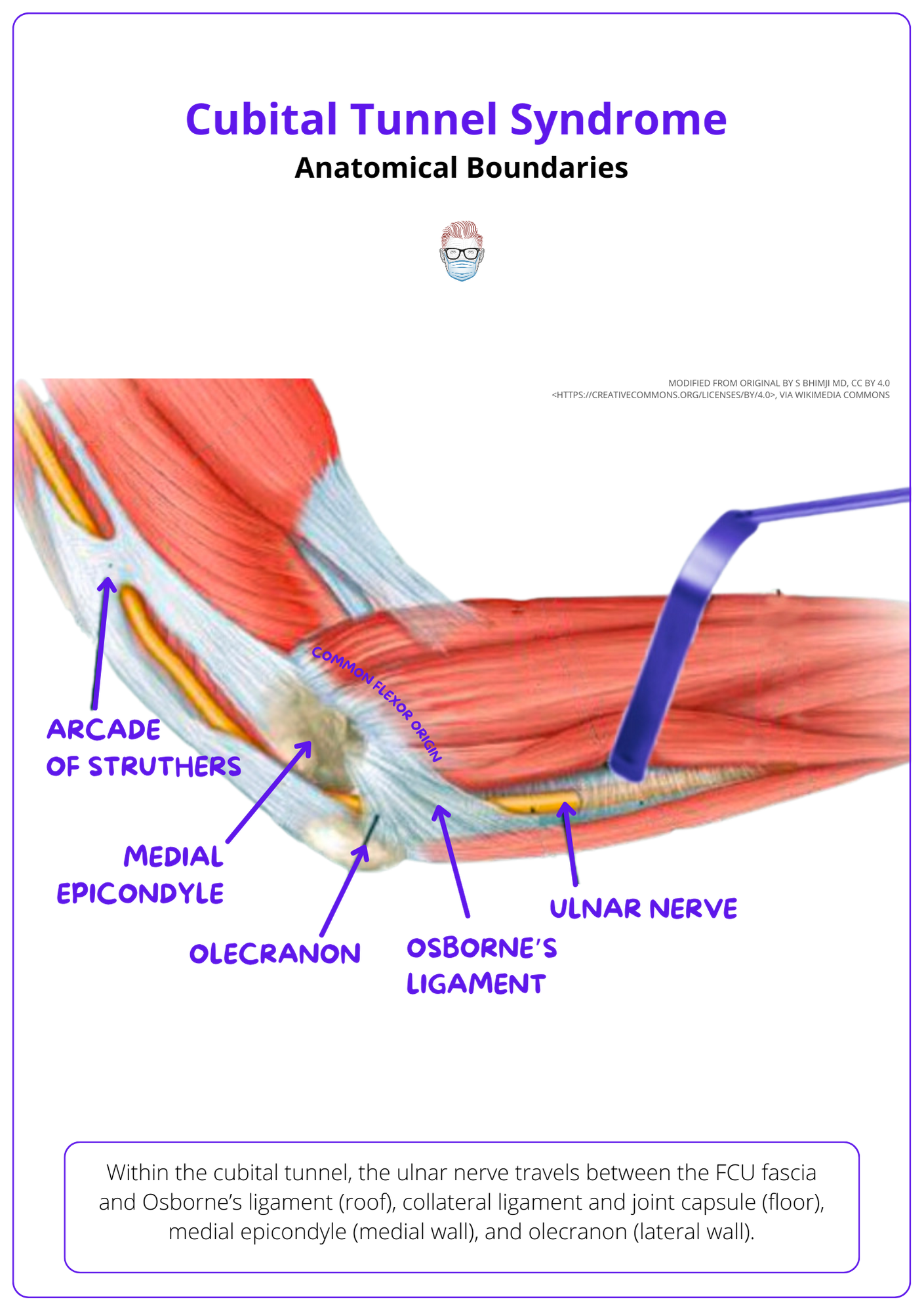 This image shows the Anatomical Boundaries of the Cubital Tunnel.