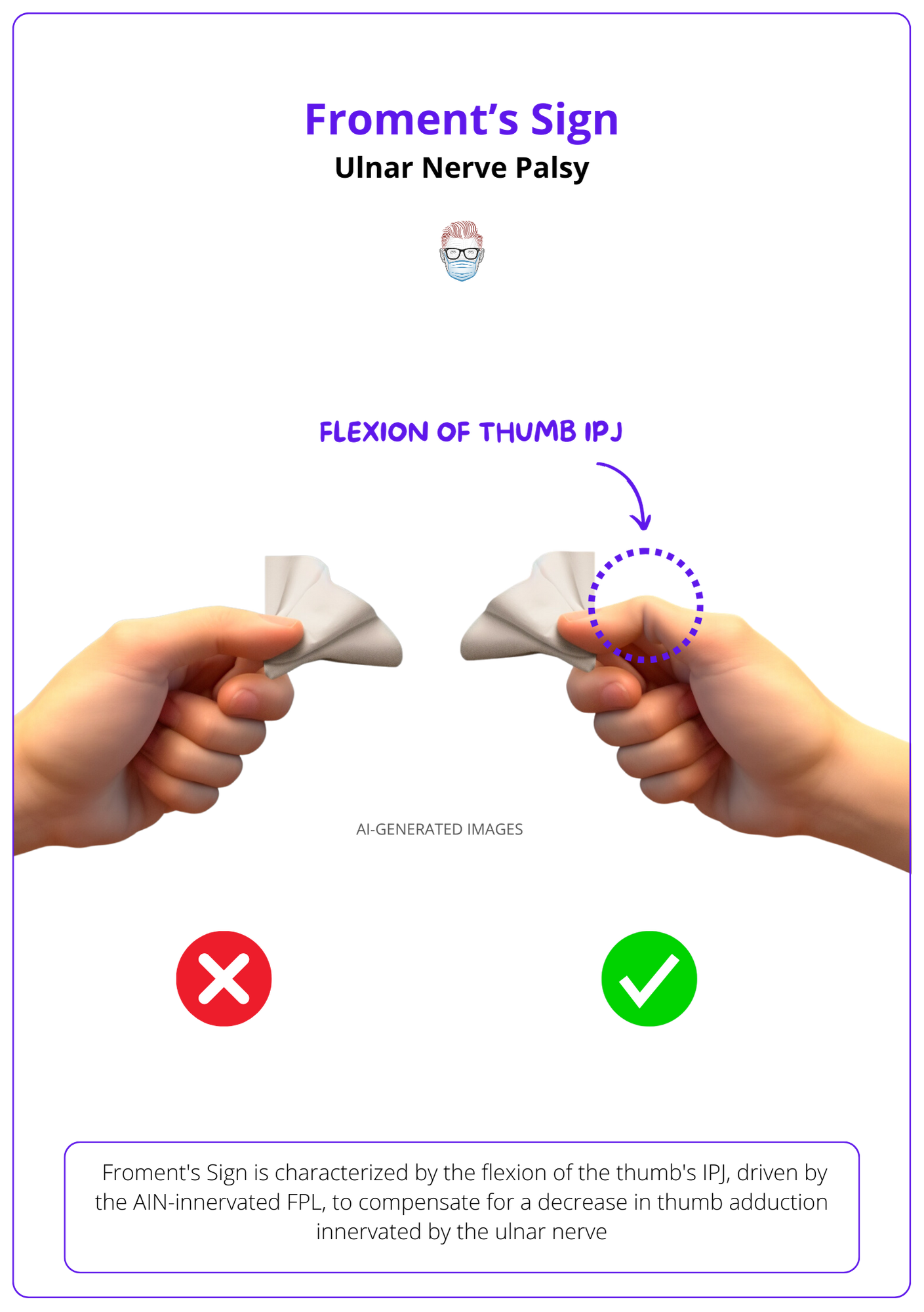 Froment's Sign in Ulnar Nerve Palsy in Cubital Tunnel Syndrome