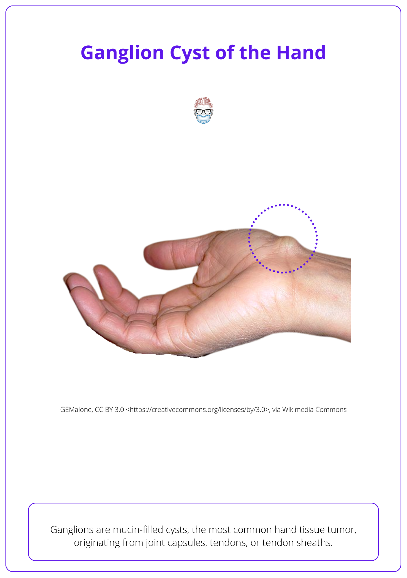 This image shows Ganglion Cysts of the hand
