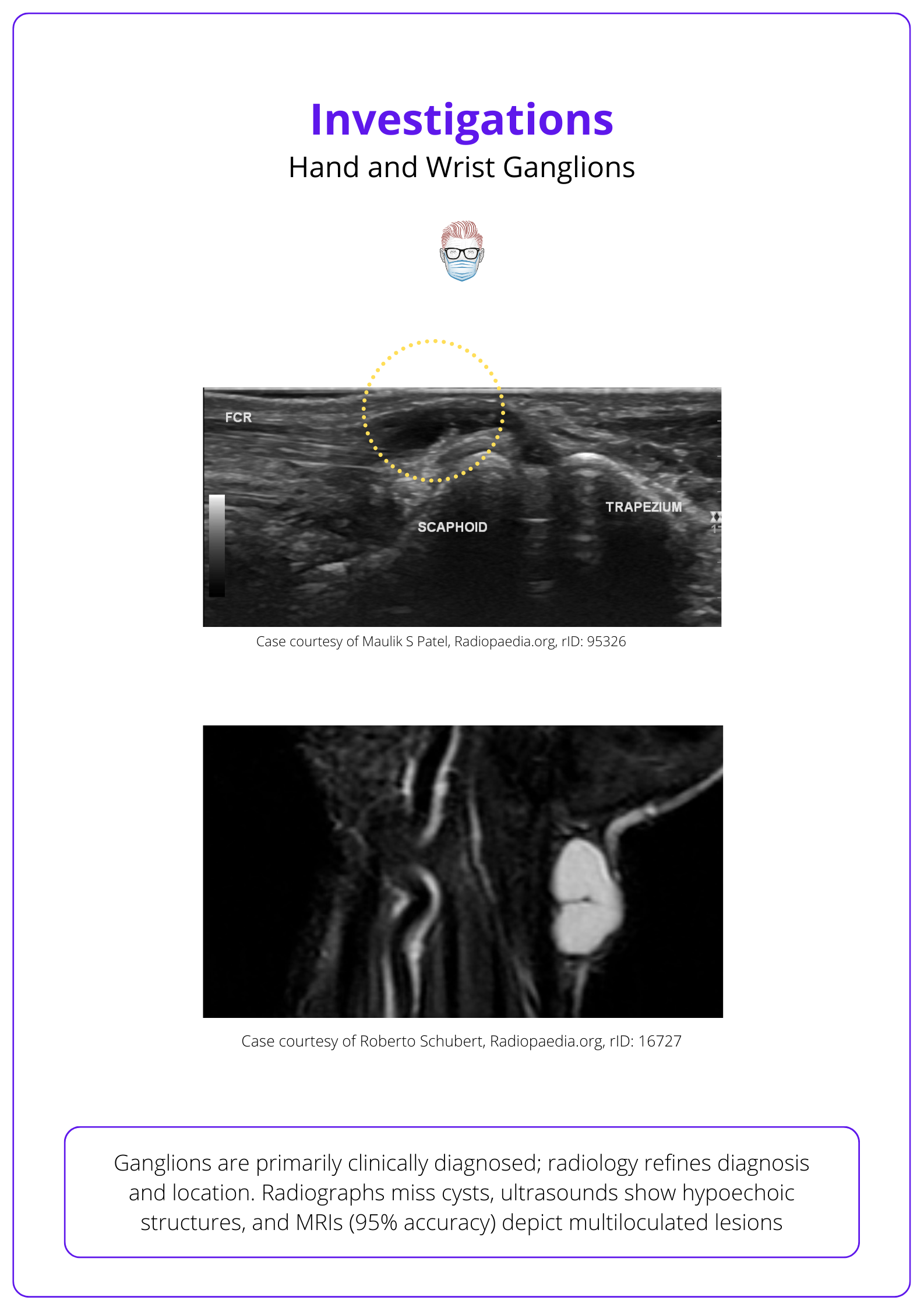 ultrasound view of hand and wrist ganglions.