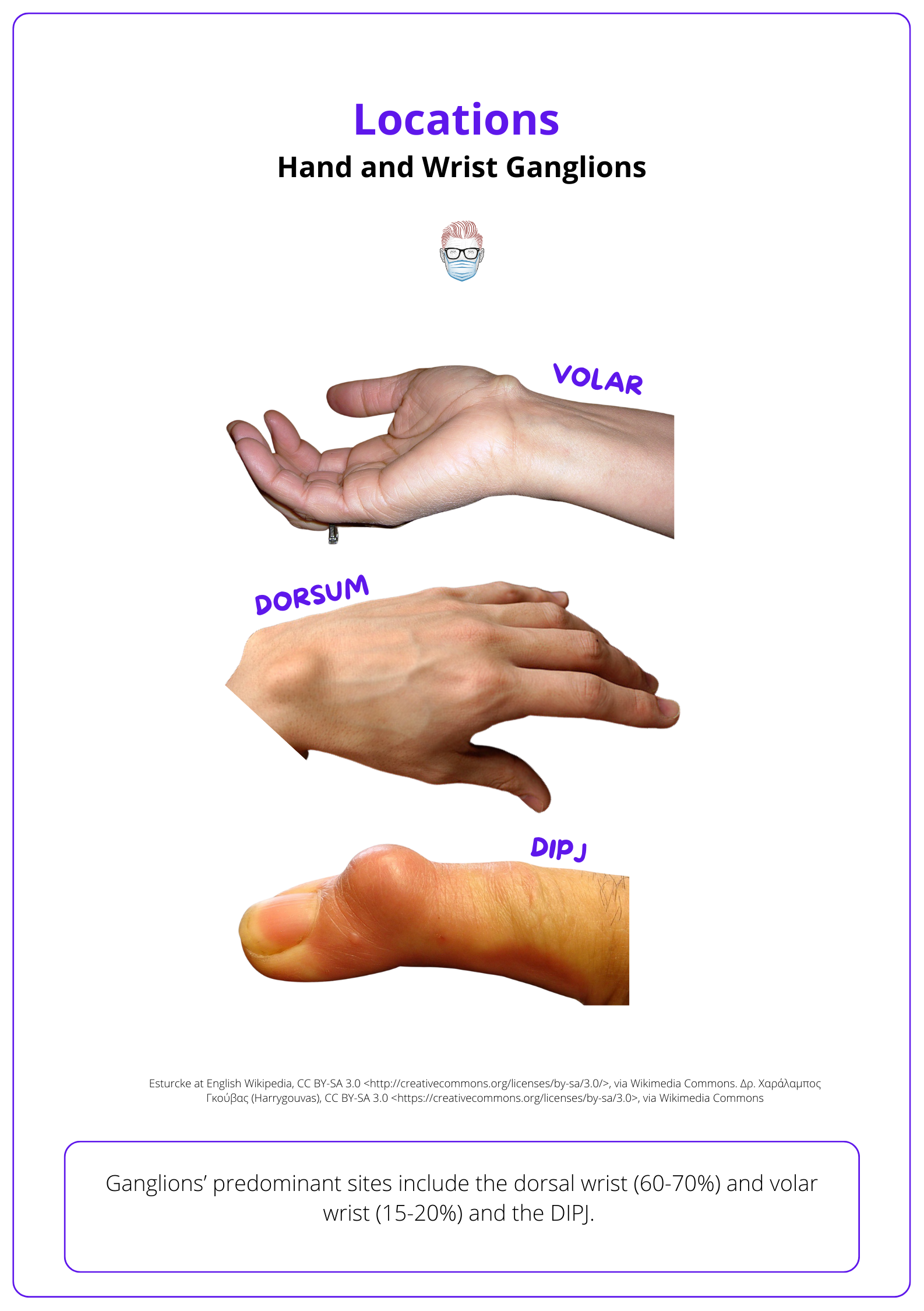 This image shows the locations of Ganglion Cysts or different types of Ganglion Cysts