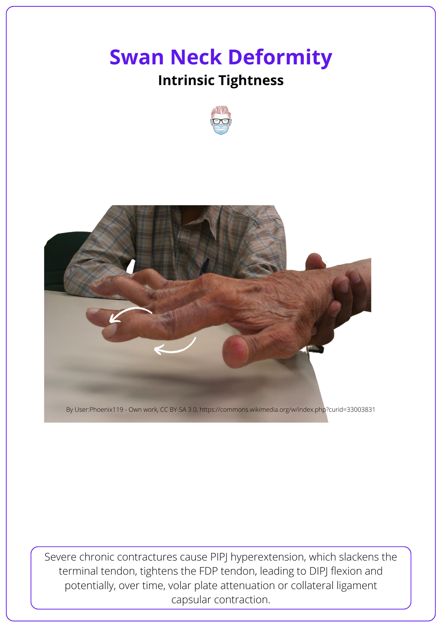 Swan Neck Deformity in Chronic Intrinsic Tightness, Intrinsic Plus Hand