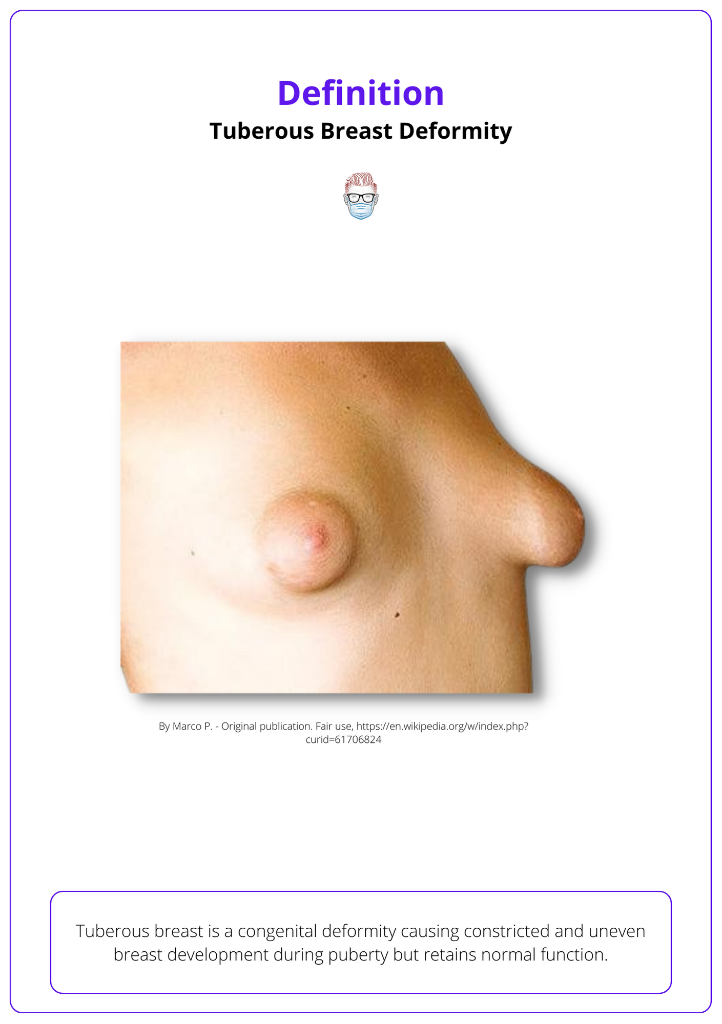 Tuberous Breast Deformity: Features, Classification, Surgery