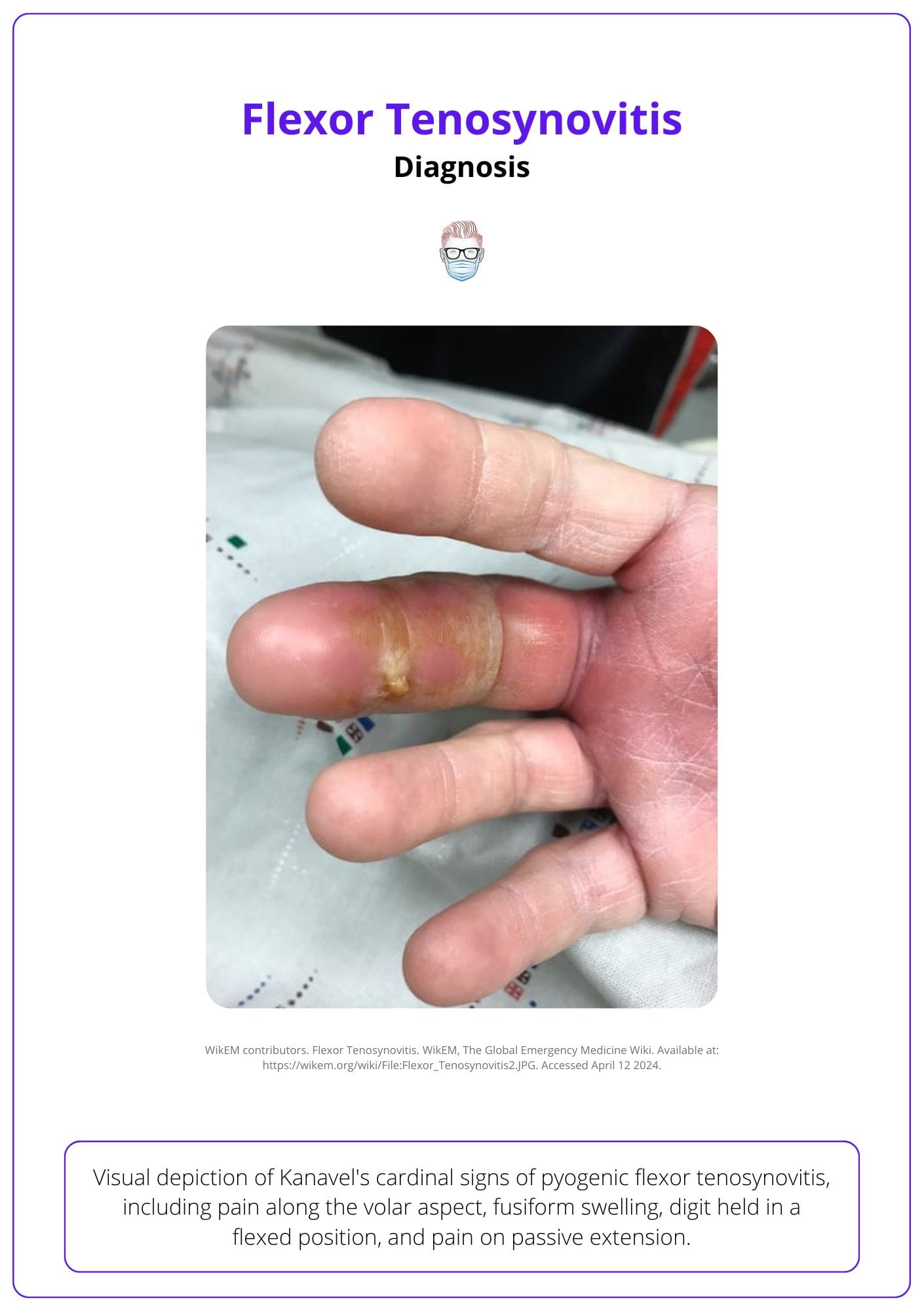 Pain on passive extension, fusiform swelling, held in passive flexion, pain along flexor sheath.