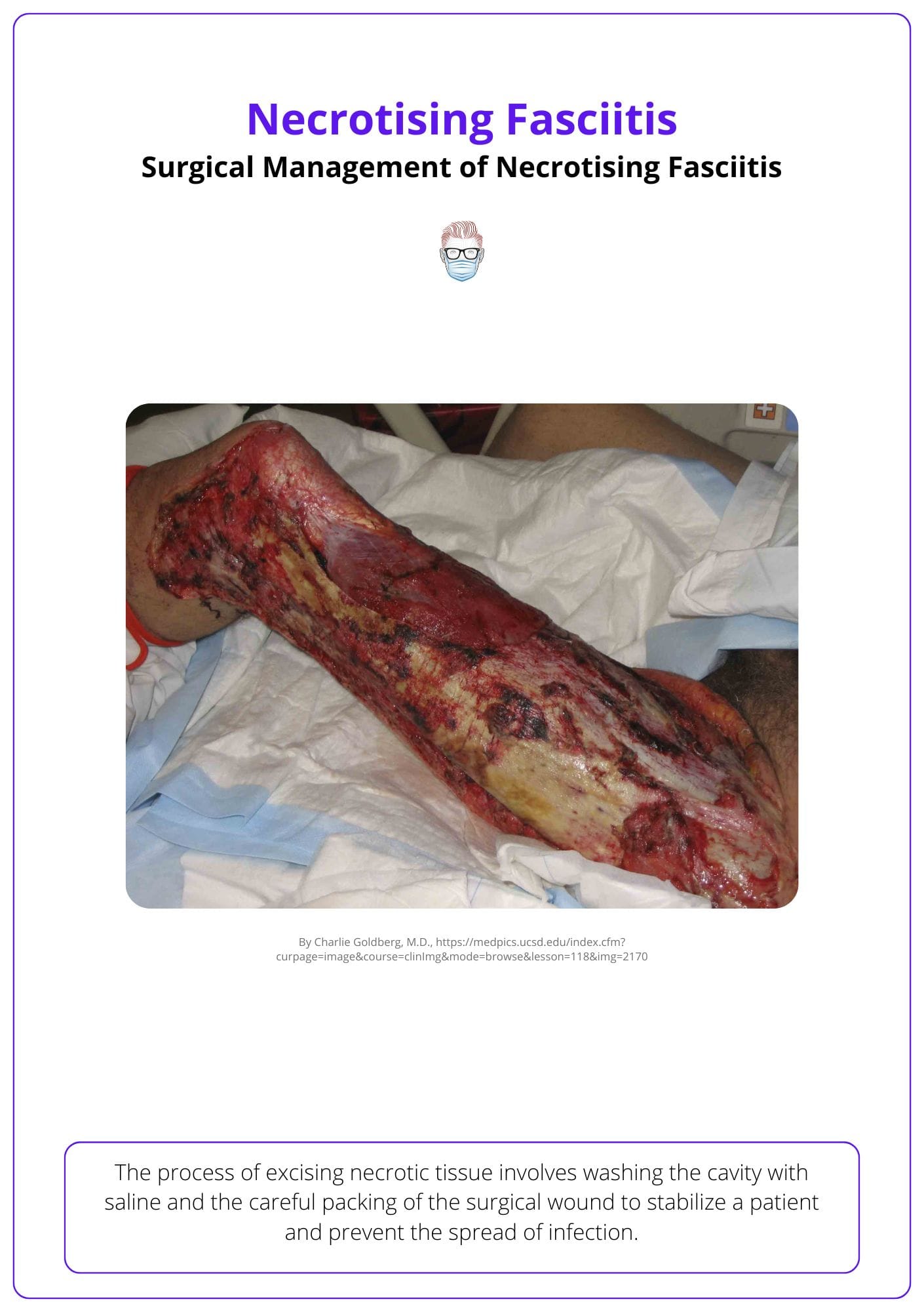 Debridement, Necrotizing Fasciitis Surgery, reconstruction