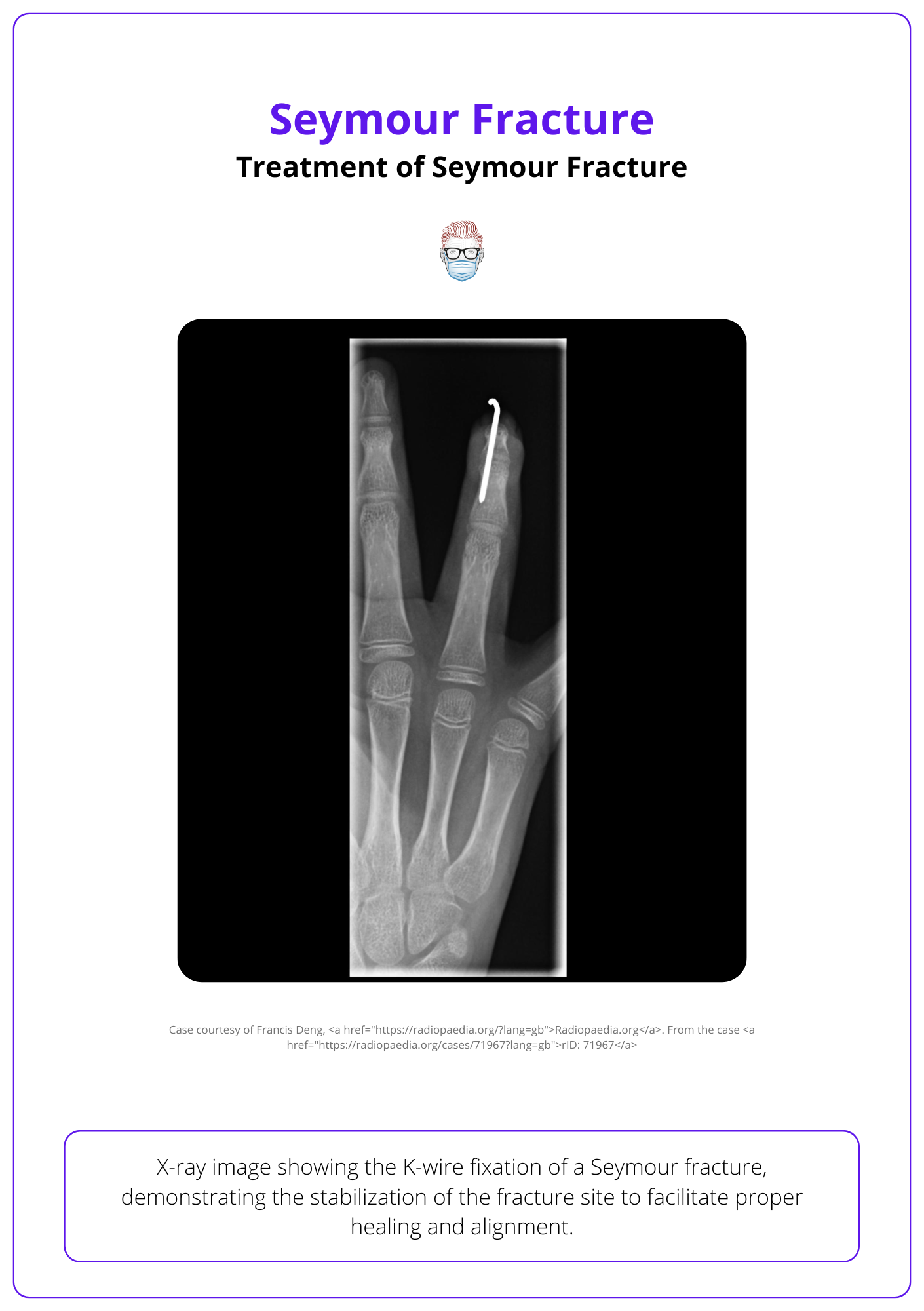 K-wire fixation of Seymour fracture