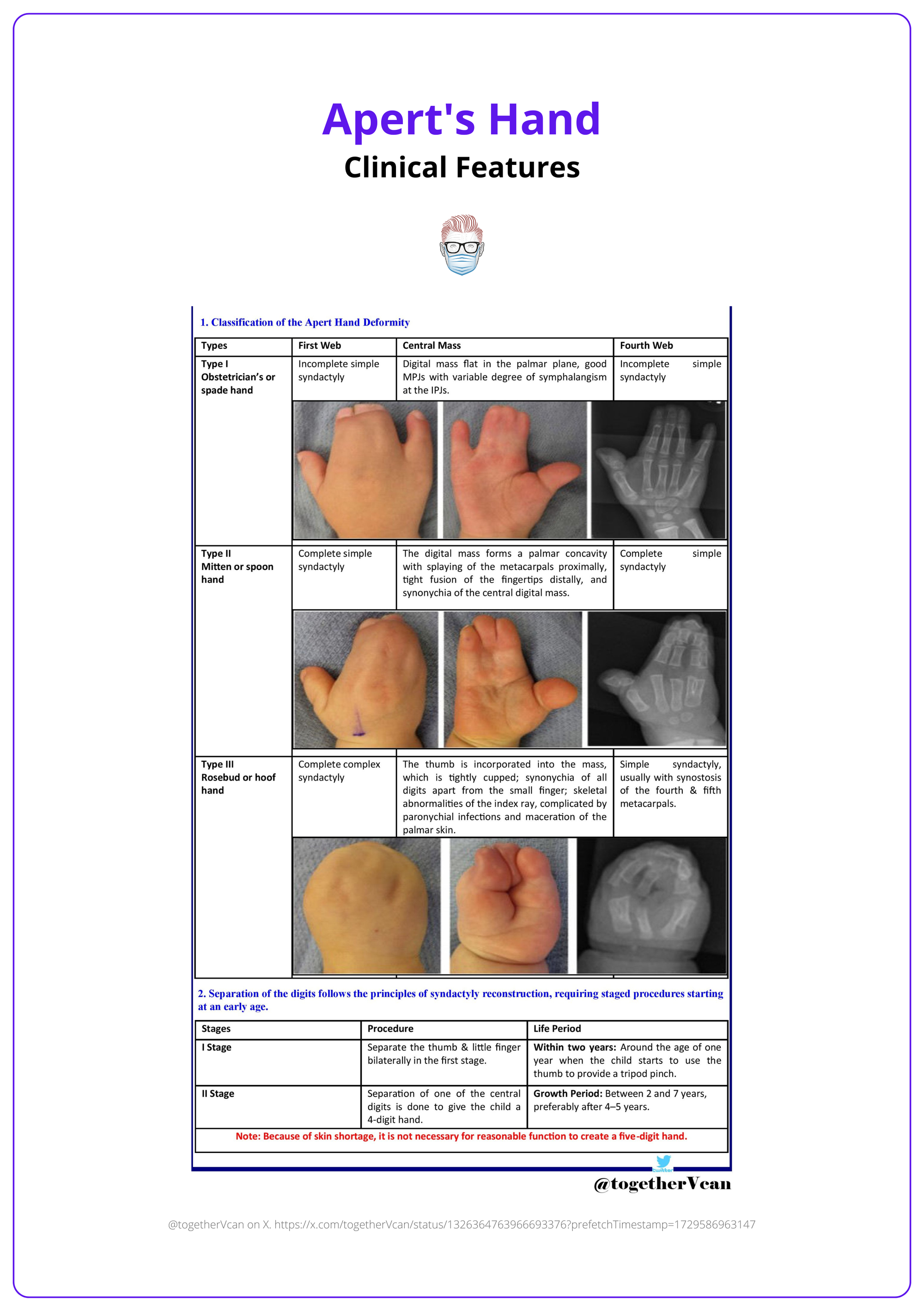 Clinical features of Apert's hand according to its types