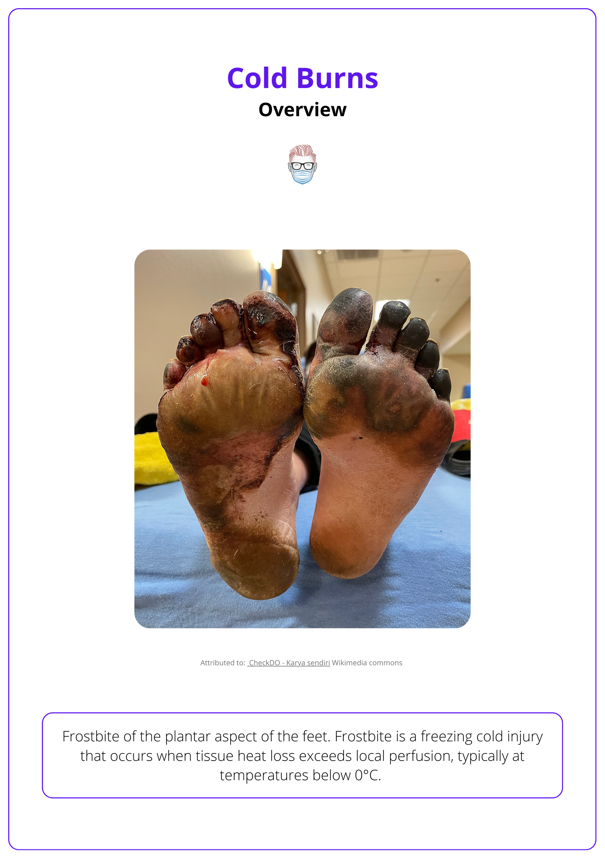 Frostbite of the plantar aspect of the feet