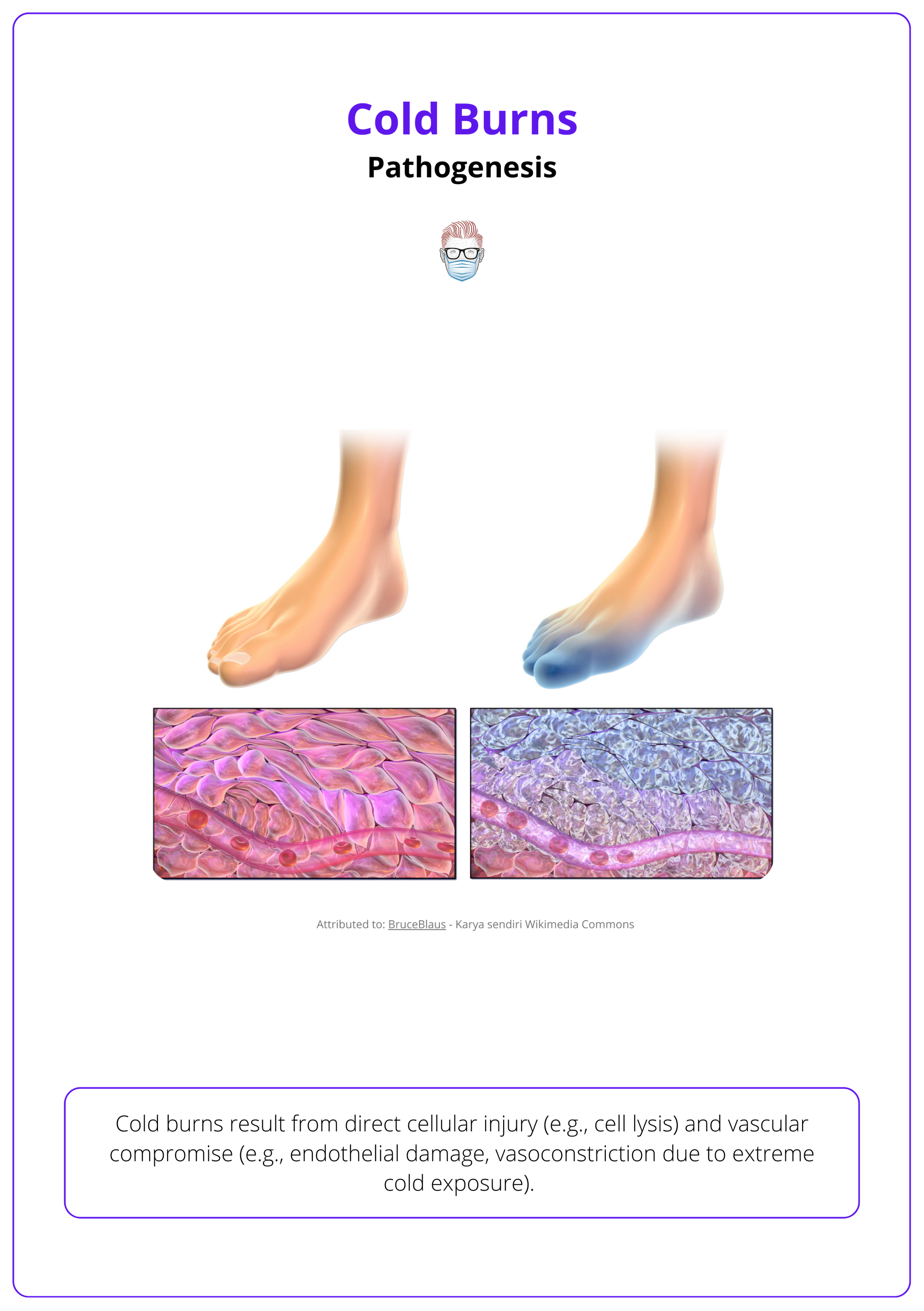 The pathophysiology of frostbite