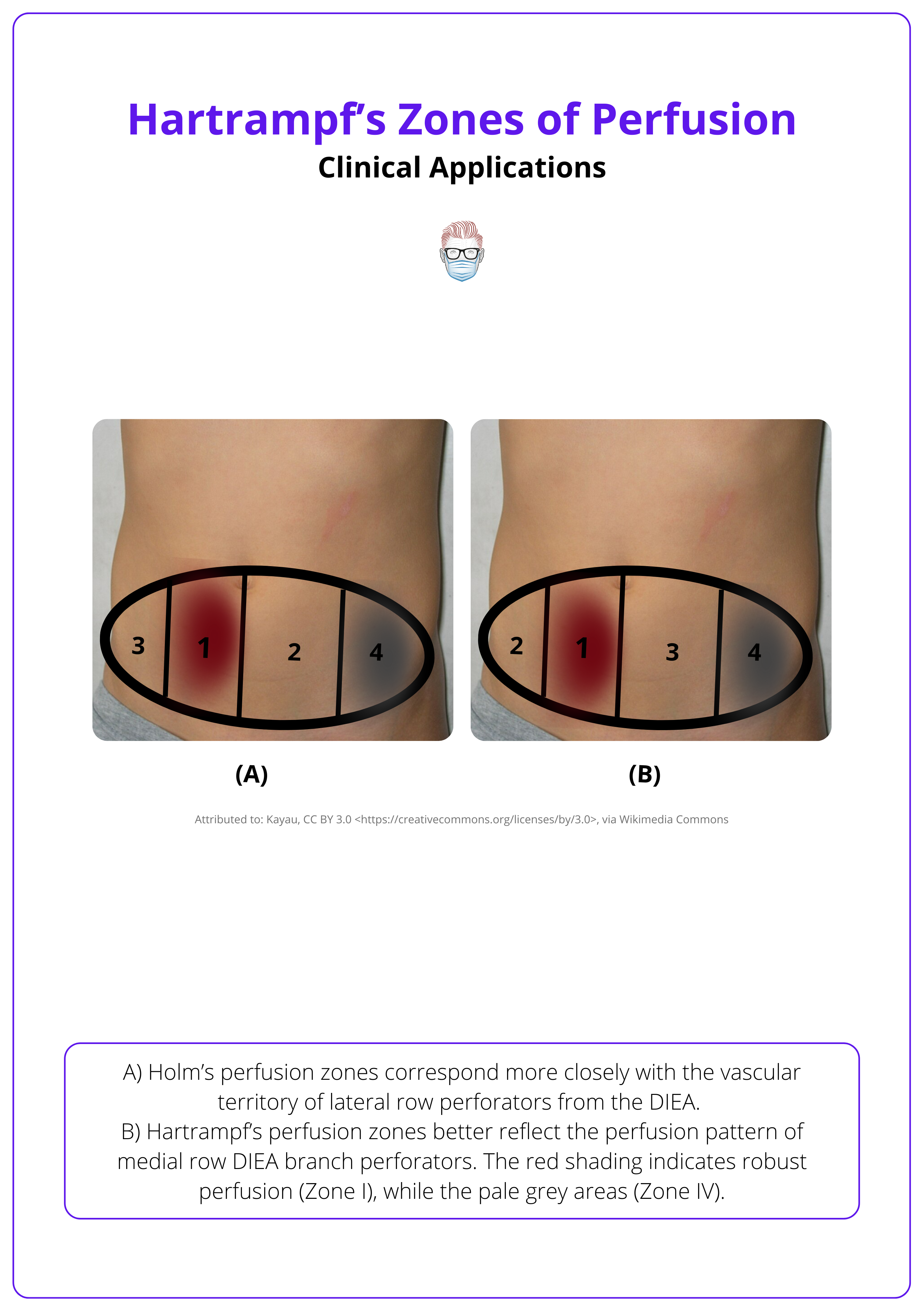 The four zones of the abdominal flap
