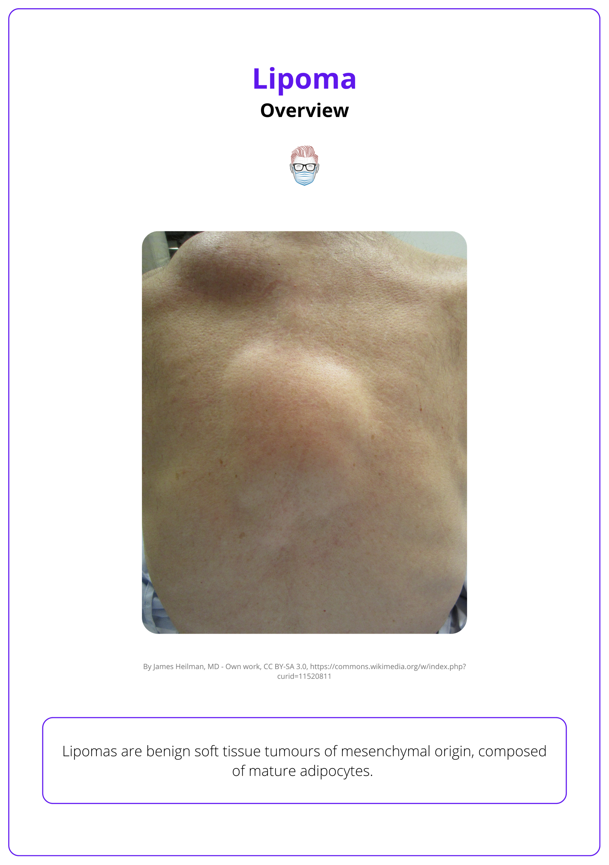 Two large lipomas on the back, overview of lipoma