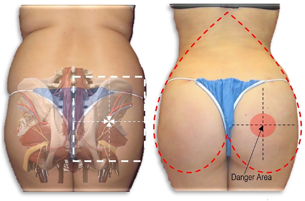 Danger Zone in Gluteal Fat Grafting